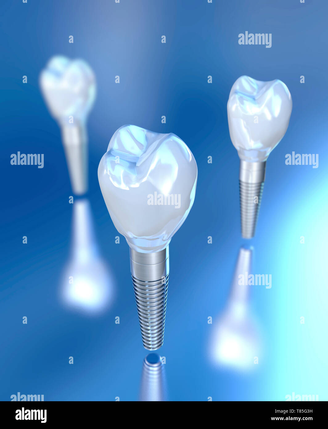 Dental implants, illustration Stock Photo