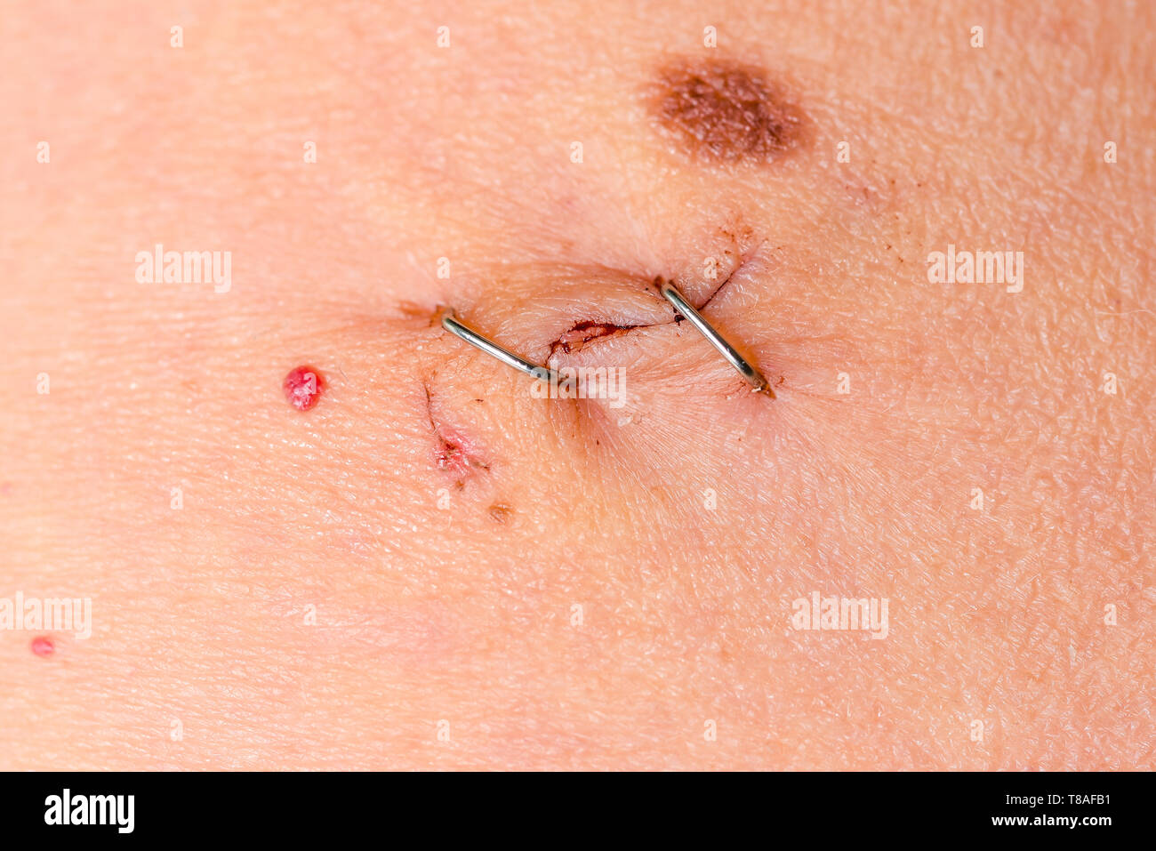 Laparotomy hires stock photography and images Alamy
