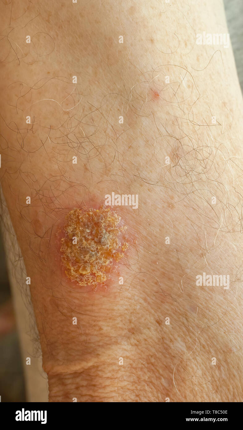 Closeup of Discoid Excema patch on arm of male-Victoria, British Columbia, Canada. Stock Photo