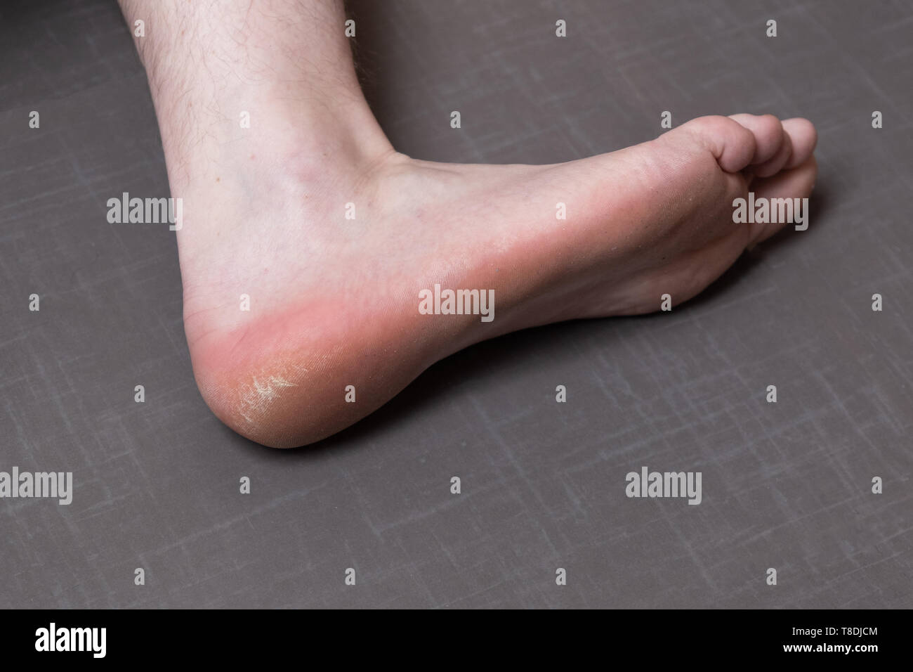 Close up of caucasian male dehydrated skin on the heels, trating callus