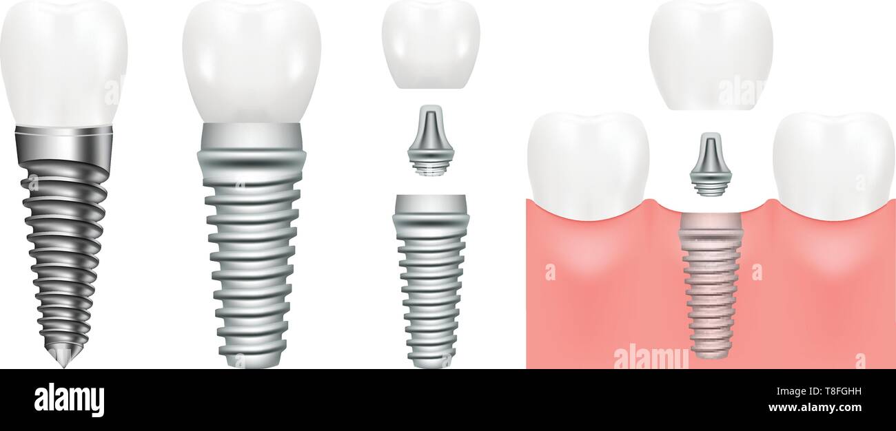 Realistic dental implant structure with all parts crown, abutment