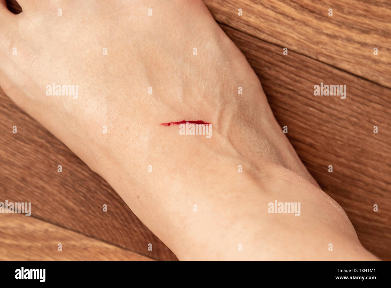 A wound on the human body, suture old, deep cut, scar closeup Stock