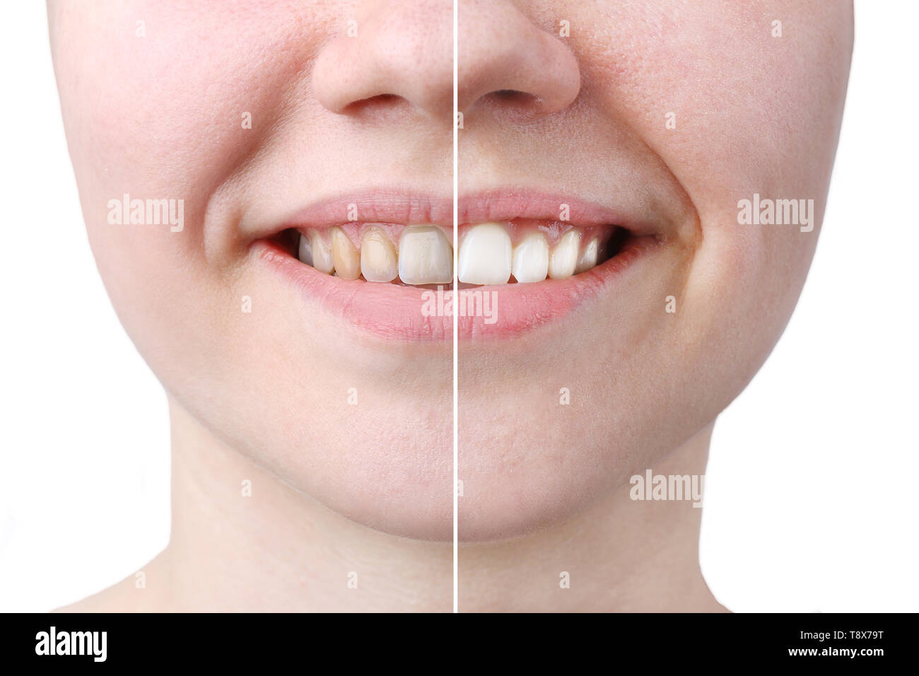 whitening or bleaching treatment ,before and after ,woman teeth and
