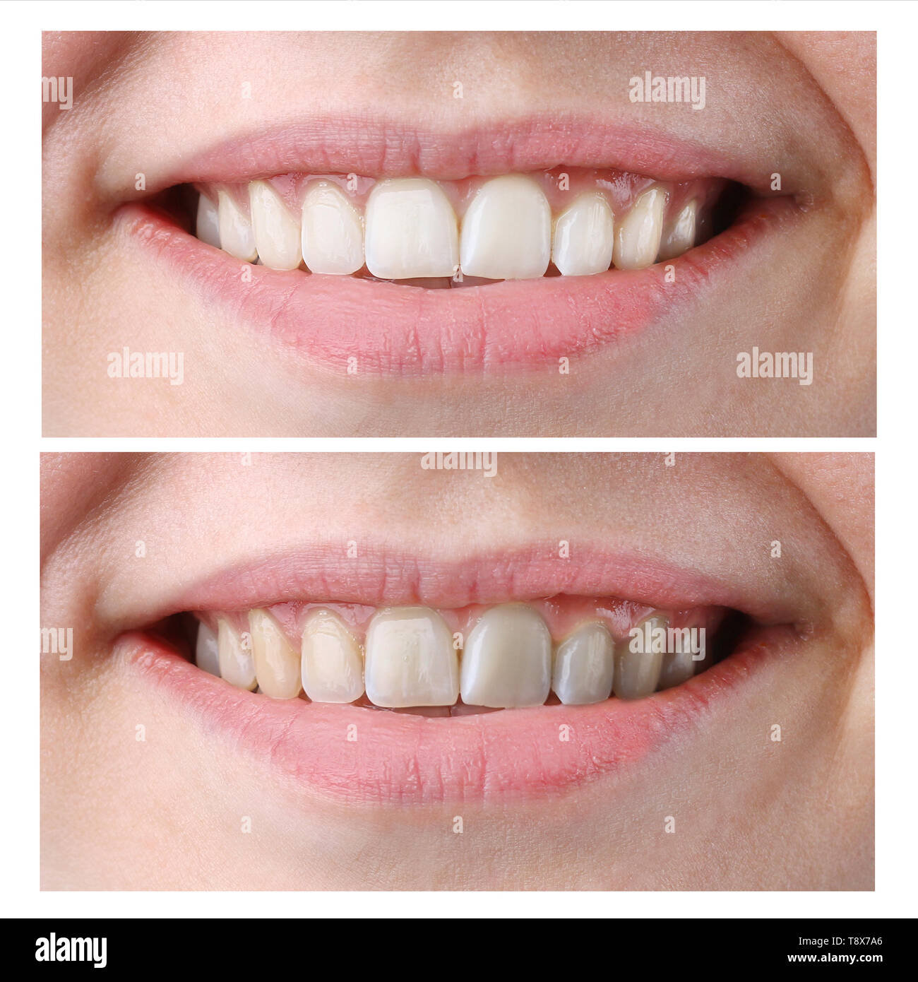 Woman Teeth Before and After Whitening on isolated white back Stock