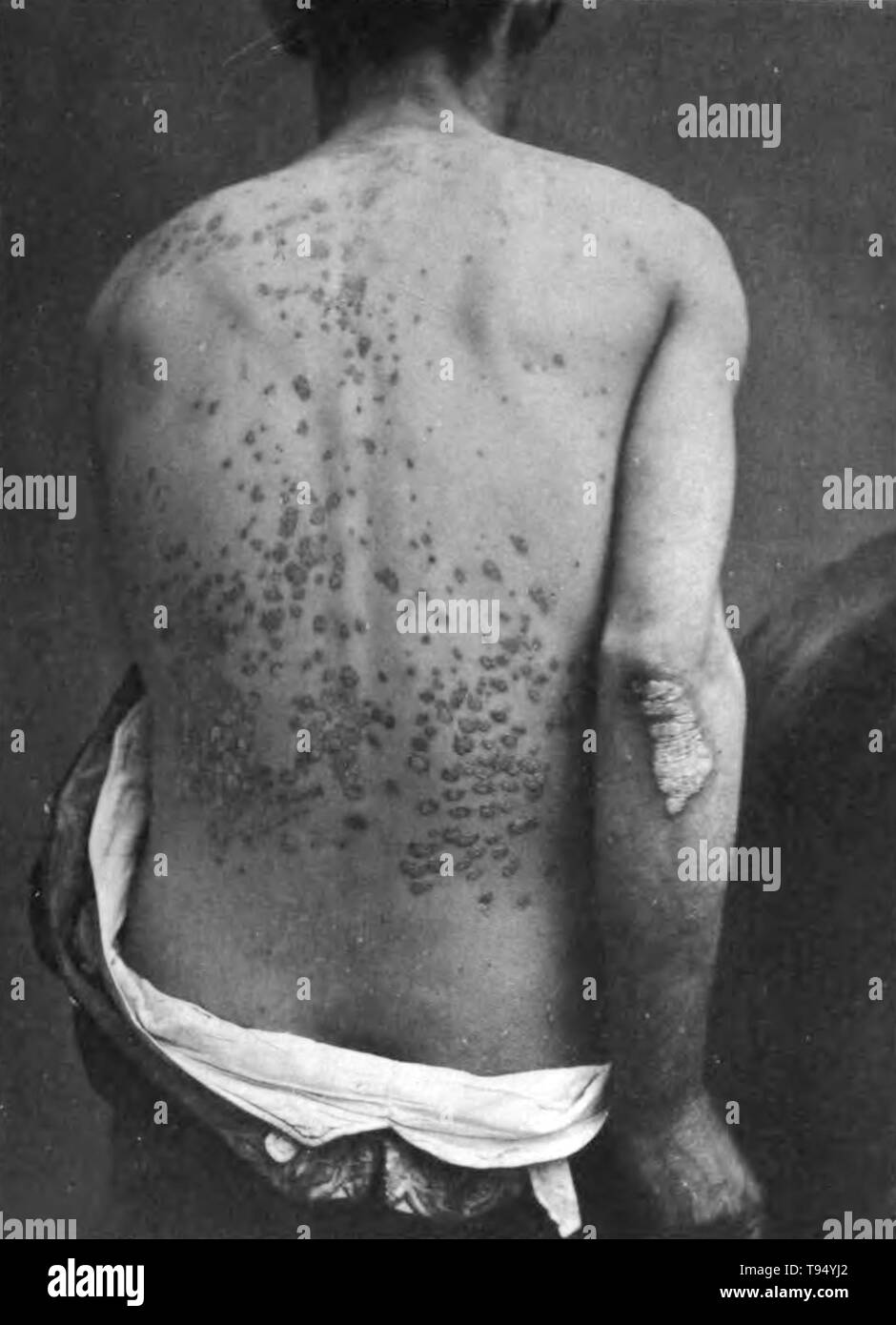 Guttate psoriasis on the back and arm of a man. Guttate psoriasis is a type of psoriasis that looks like small, salmon-pink drops on the skin. The word guttate is derived from the Latin word gutta, meaning drop. Photographed by George Henry Fox, 1886. Stock Photo
