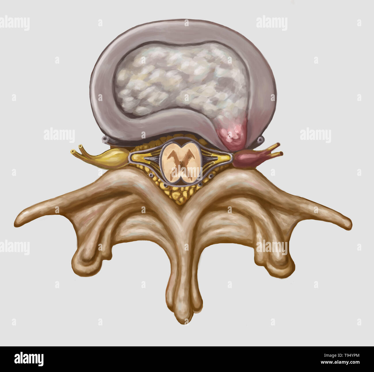 Illustration herniated spinal disk hires stock photography and images
