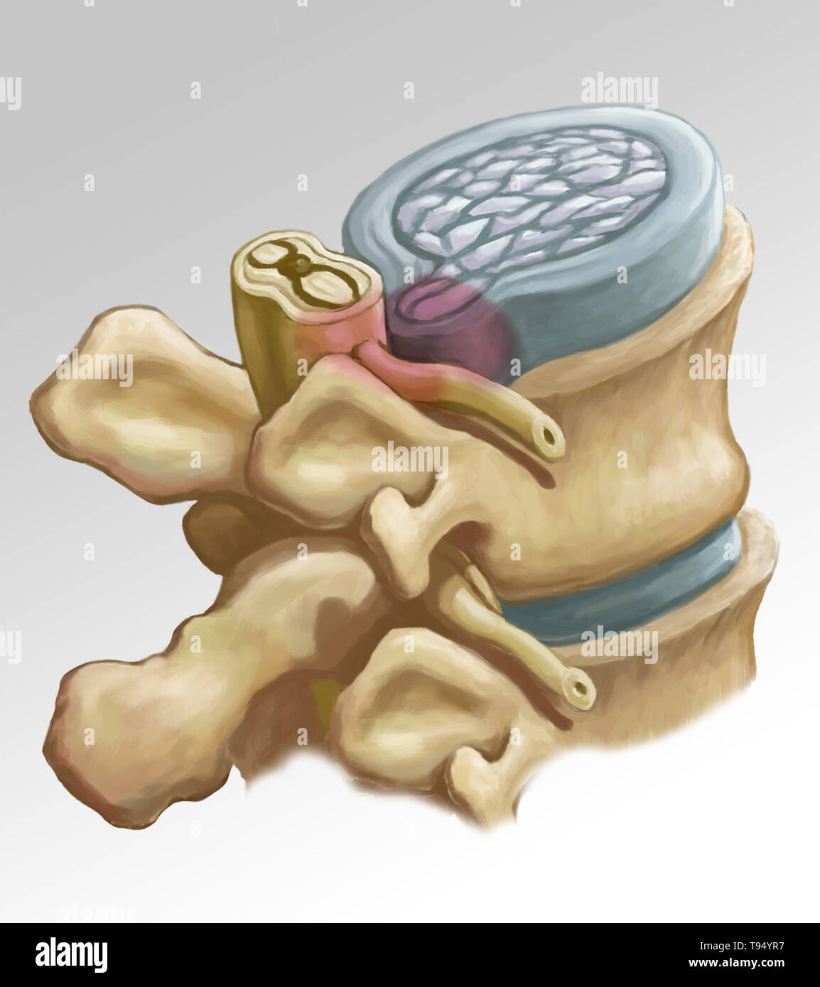 An illustration of the herniation of an intervertebral disk in the lumbar spine. Individuals suffer from a herniated disk when the outer fibrous tissue of the disk, known as the anulus fibrosus, can rupture due to trauma or old age. As a result, the gel-like center of the disk protrudes outward and compresses the nerves in the back, weakening muscles and causing severe local back pain. Stock Photo