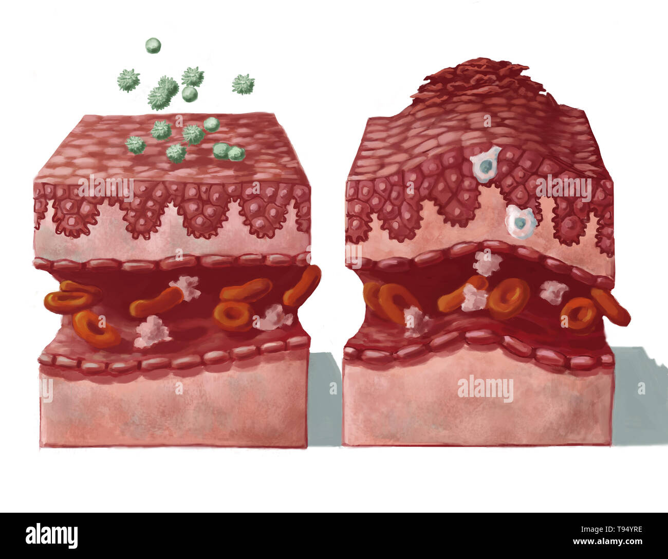 Illustration of healthy skin coming into contact with allergens (on the left) and the reaction that follows infection (on the right): dilation of blood vessels and the immune reaction of macrophages and lymphocytes that migrate to the inflammation, followed by the epidermis swelling (edema) and shedding of the upper epithelial cells. Stock Photo