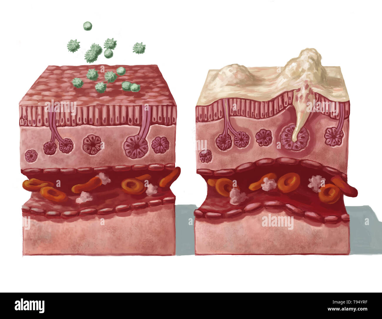 Illustration of a healthy nasal mucous membrane coming into contact with allergens (on the left) and the reaction that follows infection (on the right): overproduction of mucus, destruction of the mucous membrane epithelial, dilation of blood vessels, immune reaction in the macrophages and lymphocytes as a result of inflammation. Stock Photo