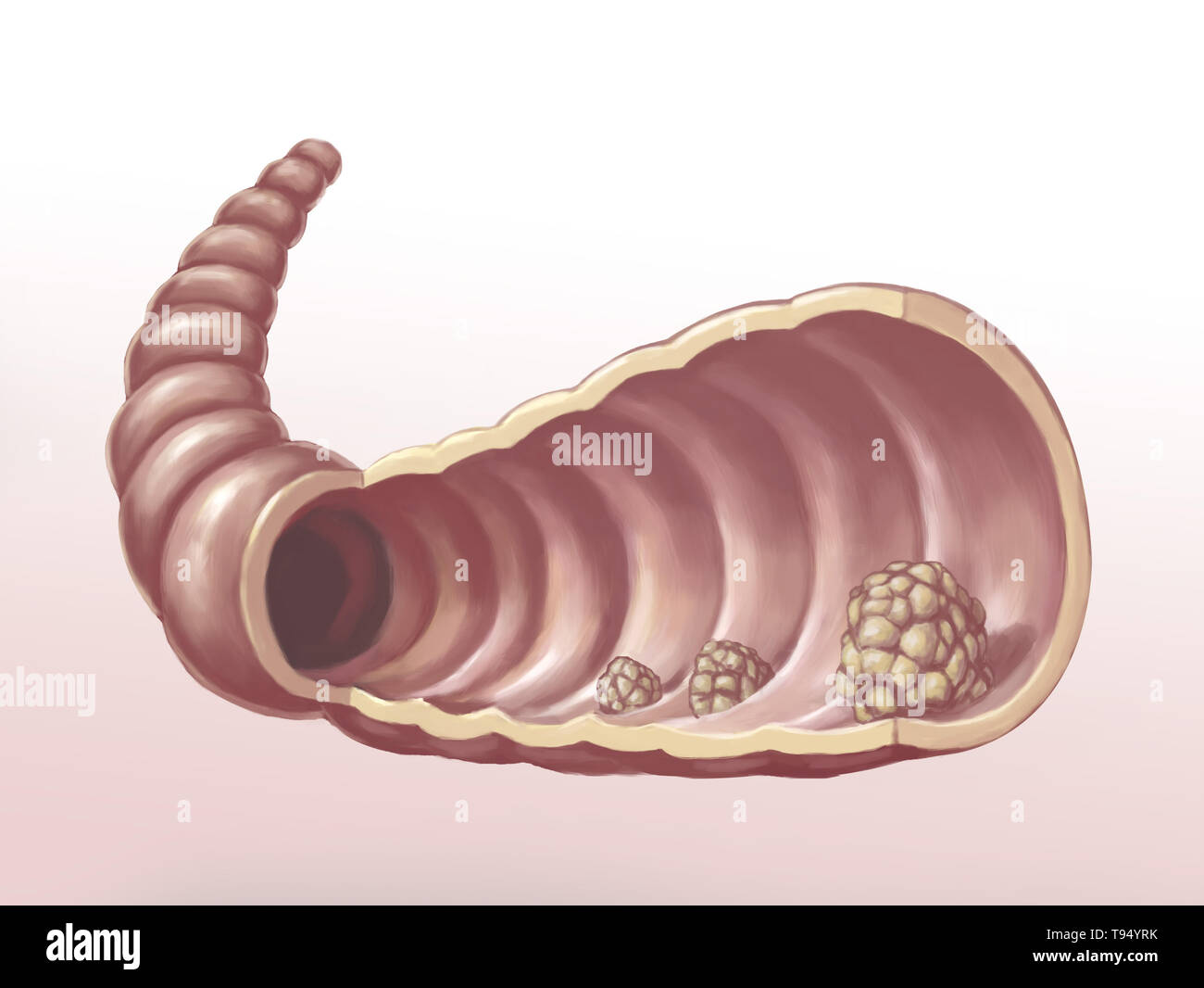 Illustration of polyps in the intestines. A polyp is an abnormal growth of tissue projecting from a mucous membrane. Stock Photo