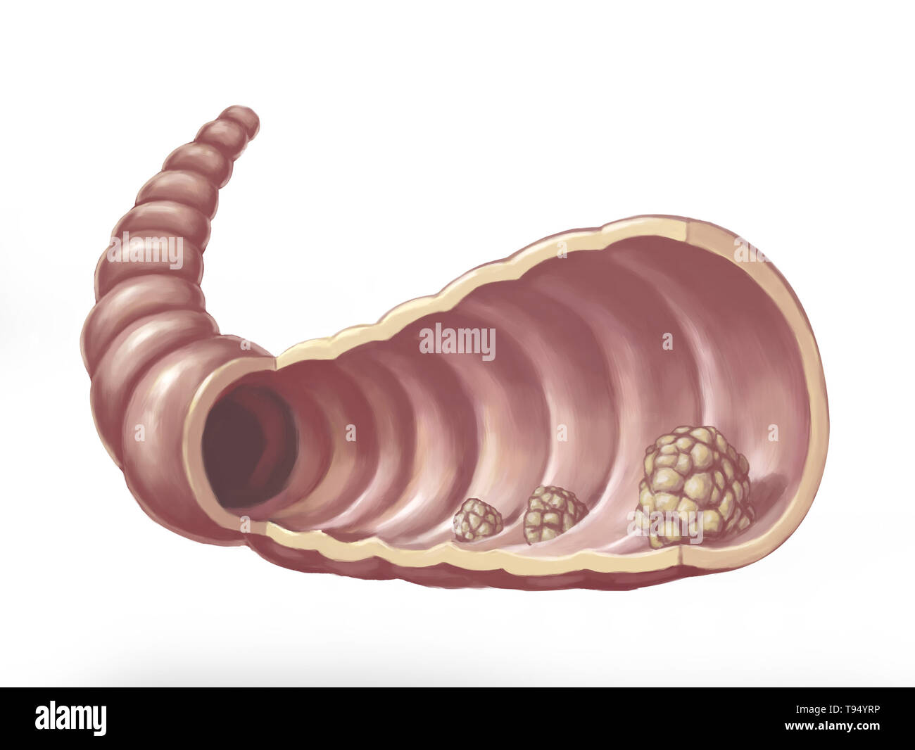 Illustration of polyps in the intestines. A polyp is an abnormal growth of tissue projecting from a mucous membrane. Stock Photo