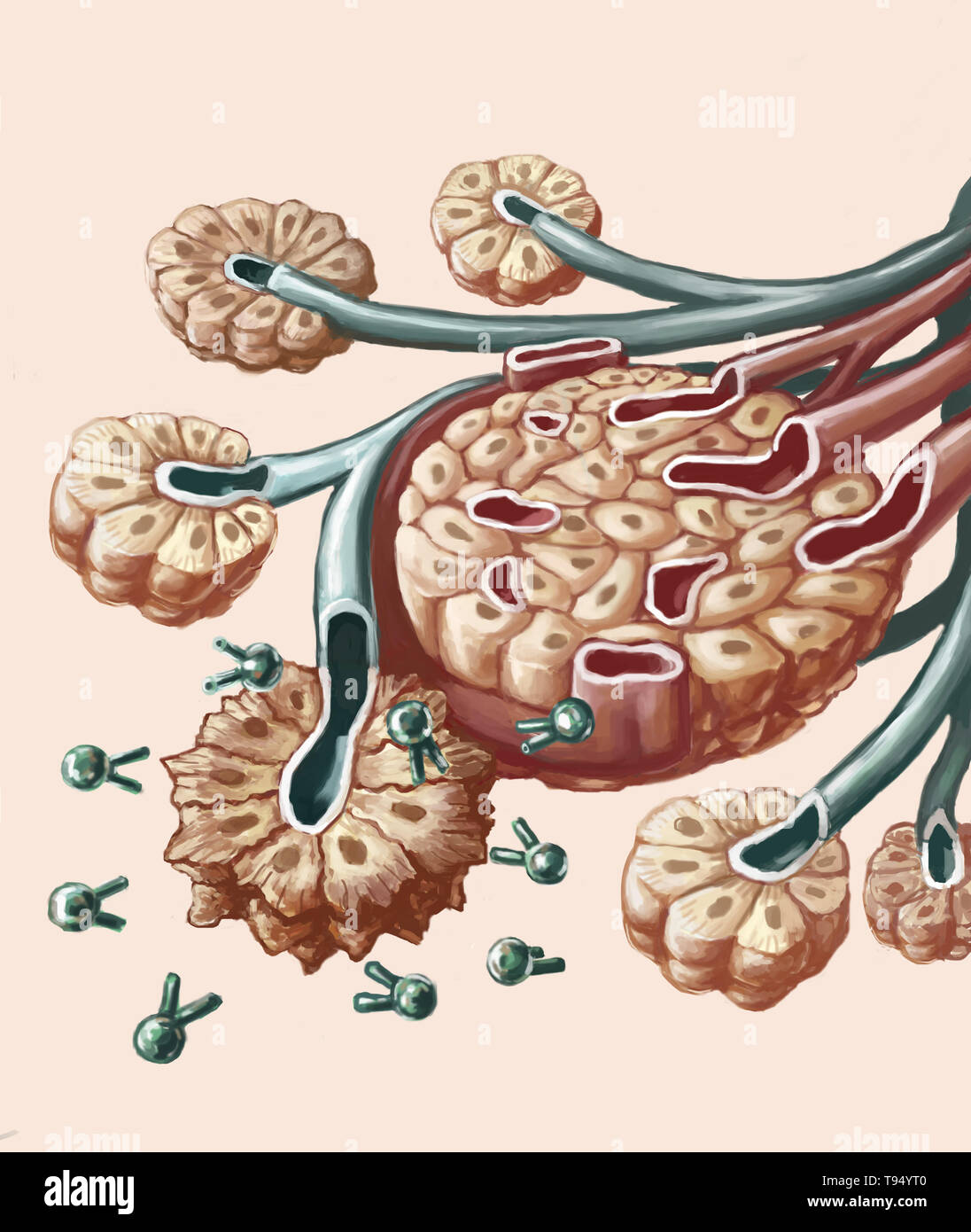 Illustration of radioimmunotherapy used to treat pancreatic cancer. A radioactive isotope (lead-212) is combined with a specific antibody capable of targeting cancerous cells. This combination of antibody and lead-212 radioisotope is injected intravenously into the body until it reaches the pancreas where it locks onto the cancerous cells' antigen. The lead destroys the cells by irradiating them. This treatment limits the toxicity on healthy cells located near the cancerous cells. Stock Photo