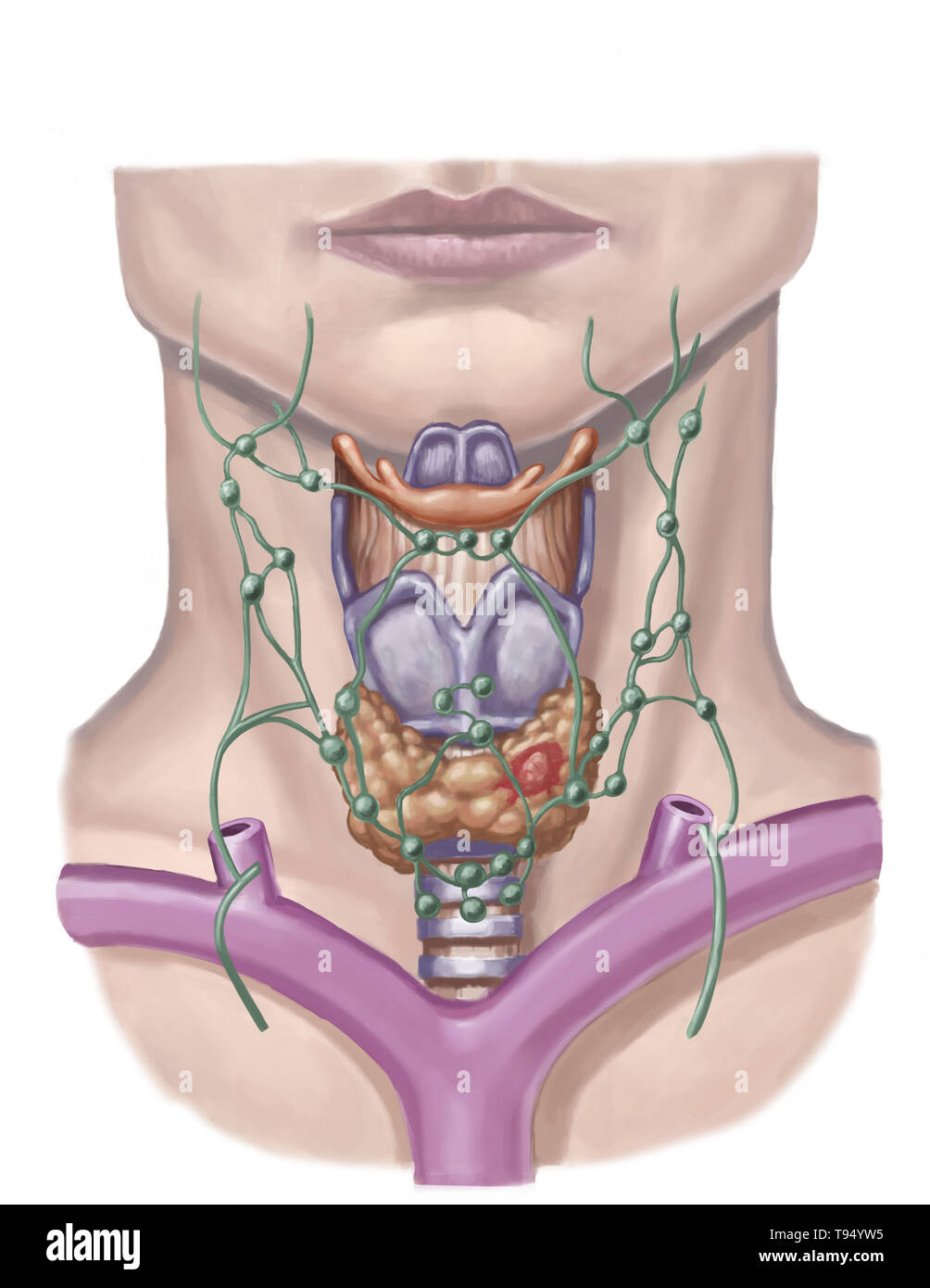 Illustration of a thyroid nodule (in red). These nodules mainly affect women and are mostly benign, but need to be watched. Stock Photo