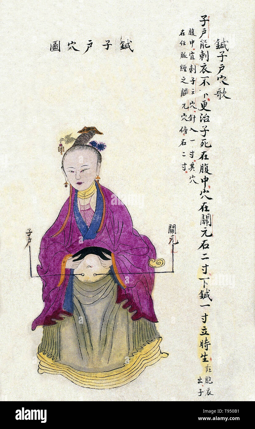 Acu-moxa point chart, showing the cervix (zihu, lit. Child Door) point, from Chuanwu lingji lu (Record of Sovereign Teachings), by Zhang Youheng, a treatise on acu-moxa in two volumes. This work survives only in a manuscript draft, completed in 1869 (8th year of the Tongzhi reign period of the Qing dynasty). The text states: The cervix point is located 2 cun to the right of the guanyuan (Pass to the Origin) point, i.e. 3 cun below the navel and 2 cun to the right. Needled vertically to a depth of 1 cun, it can be used to treat retained placenta and intrauterine death. Stock Photo