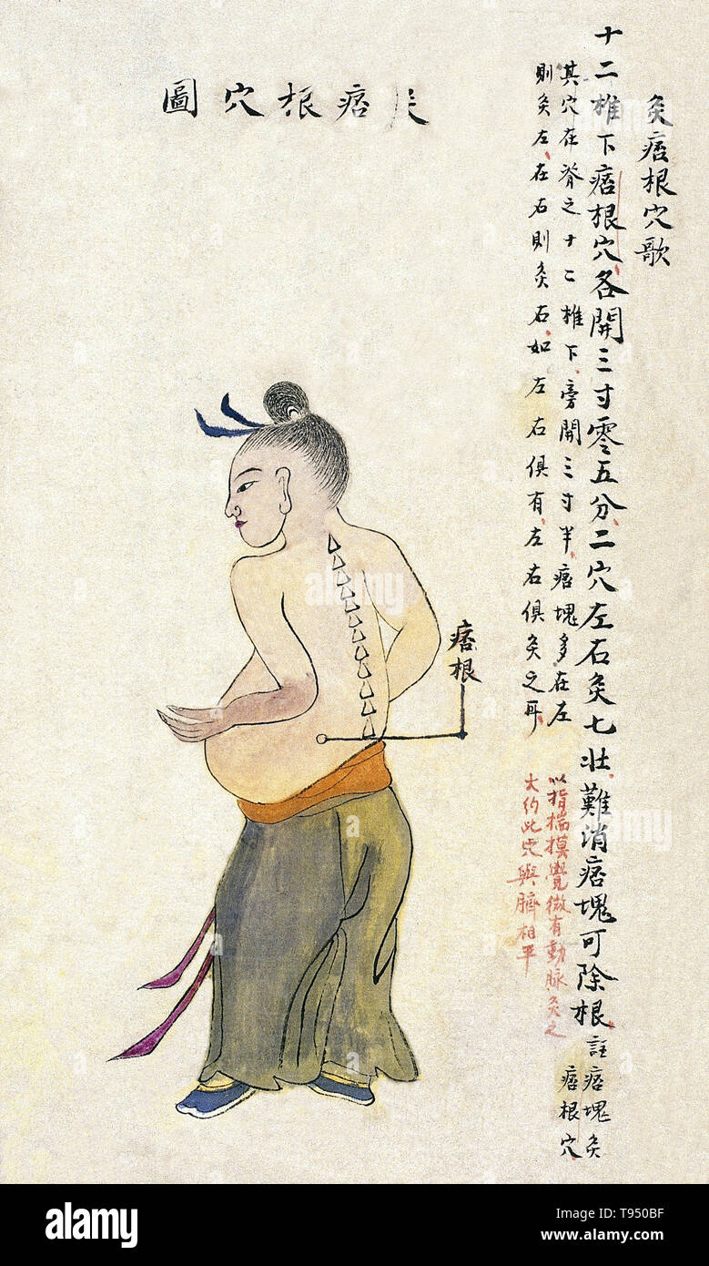 Acu-moxa point chart, showing the pigen point, from Chuanwu lingji lu  (Record of Sovereign Teachings), by Zhang Youheng, a treatise on acu-moxa  in two volumes. This work survives only in a manuscript