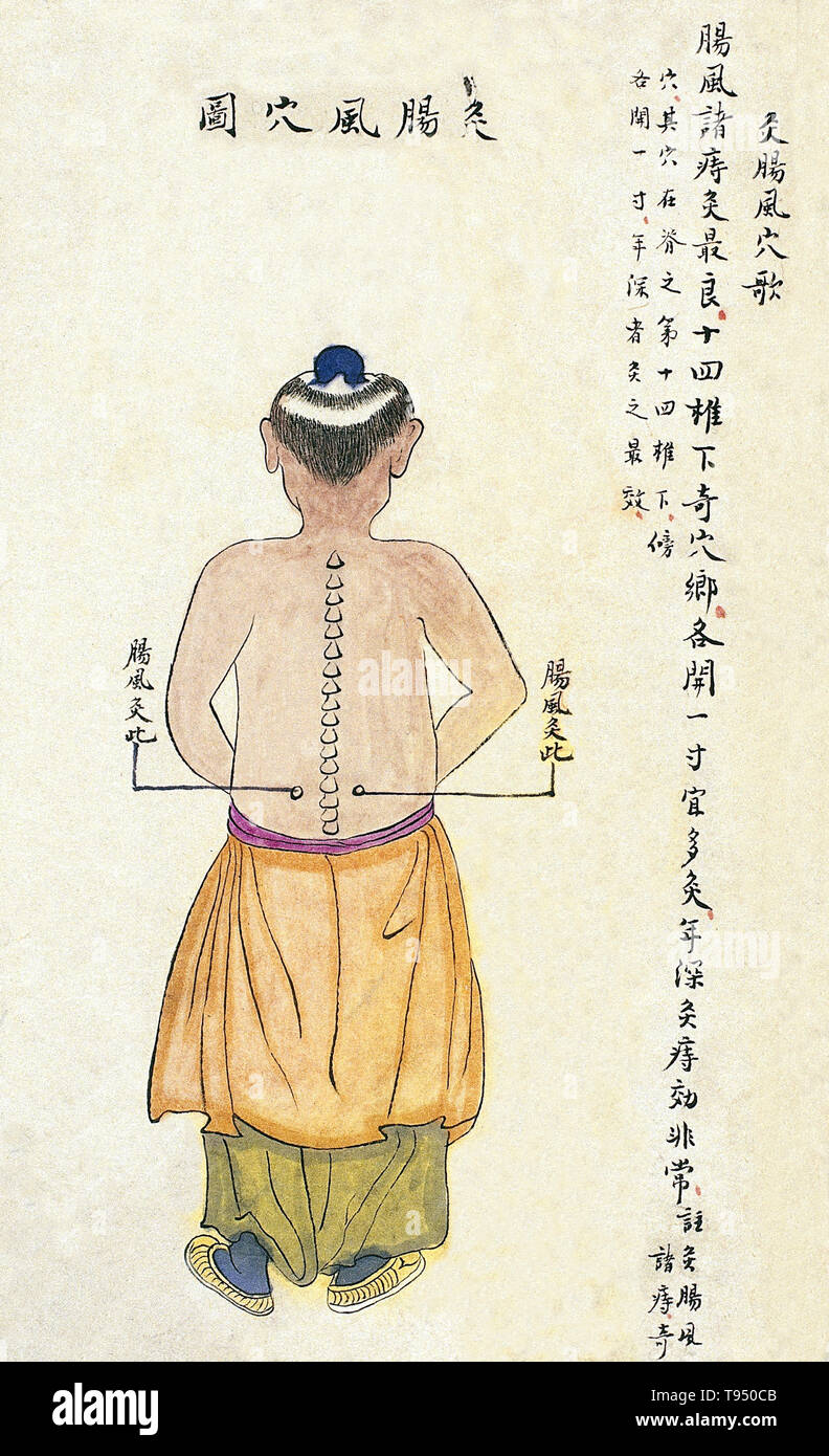 Acu-moxa point chart, showing the intestinal wind (changfeng) point, from Chuanwu lingji lu (Record of Sovereign Teachings), by Zhang Youheng, a treatise on acu-moxa in two volumes. This work survives only in a manuscript draft, completed in 1869 (8th year of the Tongzhi reign period of the Qing dynasty). The text states: The intestinal wind point is beneath the fourteenth vertebra, 1 cun to either side. Moxibustion at this point can cure intestinal wind, bloody bowel discharge (xiaxue) and chronic hemorrhoids of many years duration. Stock Photo