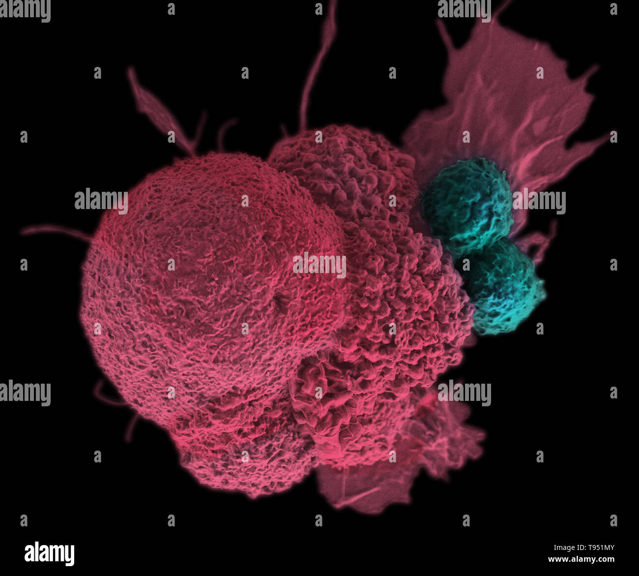 This electron micrograph (SEM) shows an oral squamous cancer cell (red) being attacked by two cytotoxic T cells (blue). The tumor-specific T cells were developed from the patient's own immune system, a personalized cancer vaccine like those that may be developed in the future with the help of NIST's standardized human genomes. This image has been colorized. Stock Photo