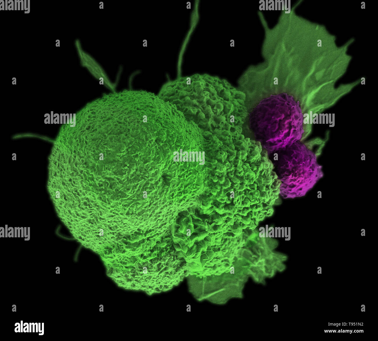 This electron micrograph (SEM) shows an oral squamous cancer cell (green) being attacked by two cytotoxic T cells (purple). The tumor-specific T cells were developed from the patient's own immune system, a personalized cancer vaccine like those that may be developed in the future with the help of NIST's standardized human genomes. This image has been colorized. Stock Photo