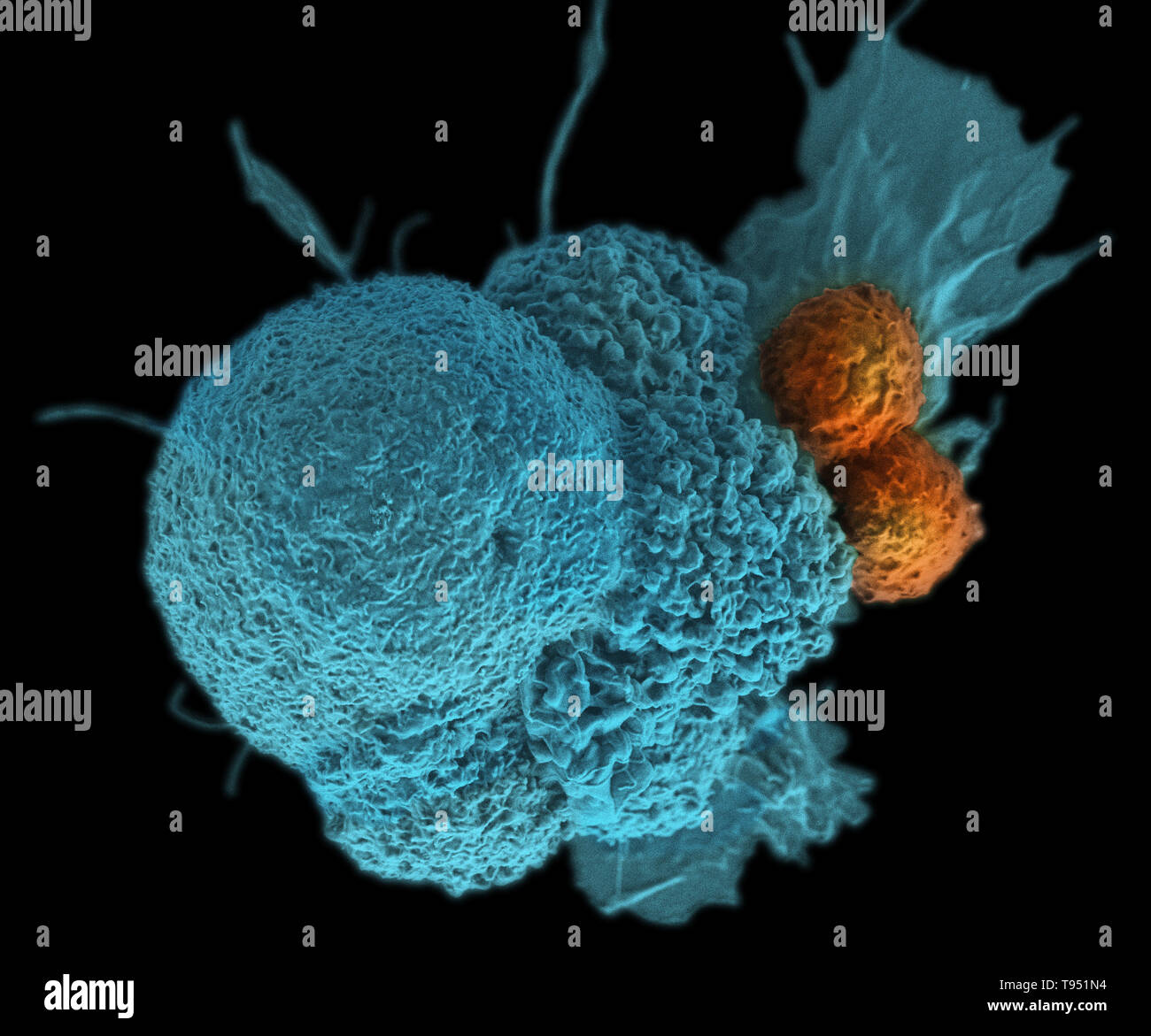 This electron micrograph (SEM) shows an oral squamous cancer cell (blue) being attacked by two cytotoxic T cells (orange). The tumor-specific T cells were developed from the patient's own immune system, a personalized cancer vaccine like those that may be developed in the future with the help of NIST's standardized human genomes. This image has been colorized. Stock Photo