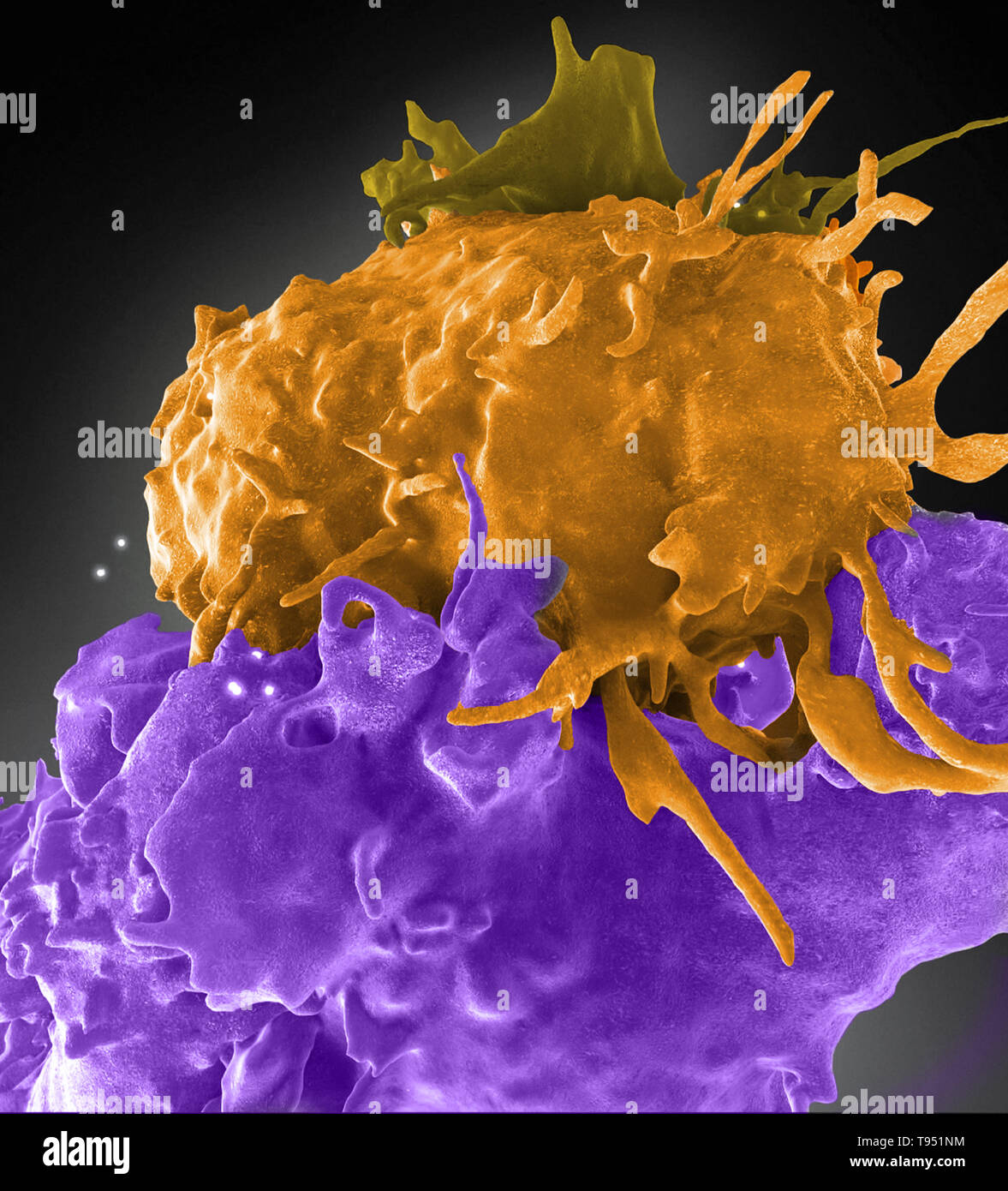 Three-dimensional structure of HIV infected (blue, green) and uninfected (brown, purple) T cells interacting. One cell (brown) has wrapped an extension around its uninfected neighbor (purple) to reach an infected cell (blue). Acquired immunodeficiency syndrome (AIDS) is a chronic, potentially life-threatening condition caused by the human immunodeficiency virus (HIV). By damaging your immune system, HIV interferes with your body's ability to fight the organisms that cause disease. Stock Photo