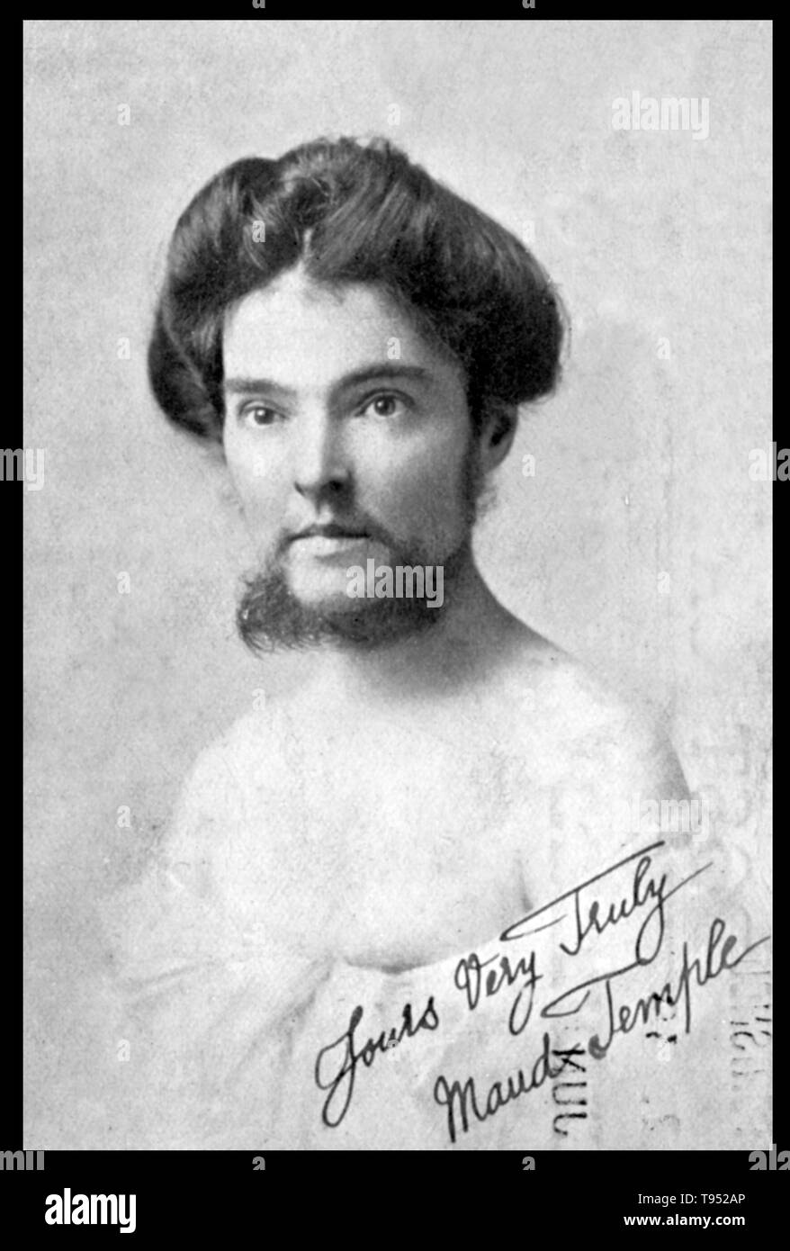 Maud Temple, a bearded lady at Pickard's Waxwork exhibition, Glasgow, 1910. She was a popular 'bearded lady' who made appearances in England and Australia. A relatively small number of women are able to grow enough facial hair to have a distinct beard. In some cases, female beard growth is the result of a hormonal imbalance (usually androgen excess), or a rare genetic disorder known as hypertrichosis. Sometimes it is caused by use of anabolic steroids. Stock Photo