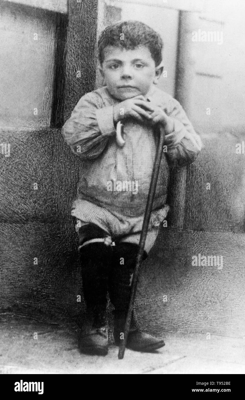 Little child having rickets whose leg was broken and now set because of the hasty evacuation of his home town to escape the Germans. Rickets is among the most frequent childhood diseases in many developing countries. The predominant cause is a vitamin D deficiency, but lack of adequate calcium in the diet may also lead to rickets. A sufficient amount of ultraviolet B light in sunlight each day and adequate supplies of calcium and phosphorus in the diet can prevent rickets. Stock Photo