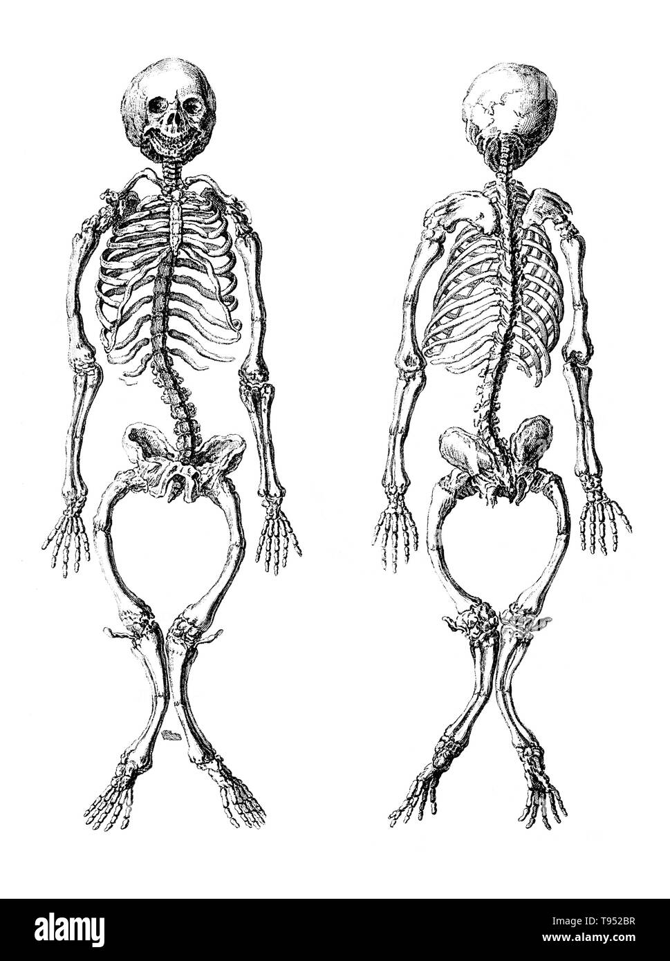 A rachitic skeleton, measuring two feet two inches in length, seen from the front and the back. Rickets is among the most frequent childhood diseases in many developing countries. The predominant cause is a vitamin D deficiency, but lack of adequate calcium in the diet may also lead to rickets. A sufficient amount of ultraviolet B light in sunlight each day and adequate supplies of calcium and phosphorus in the diet can prevent rickets. Stock Photo