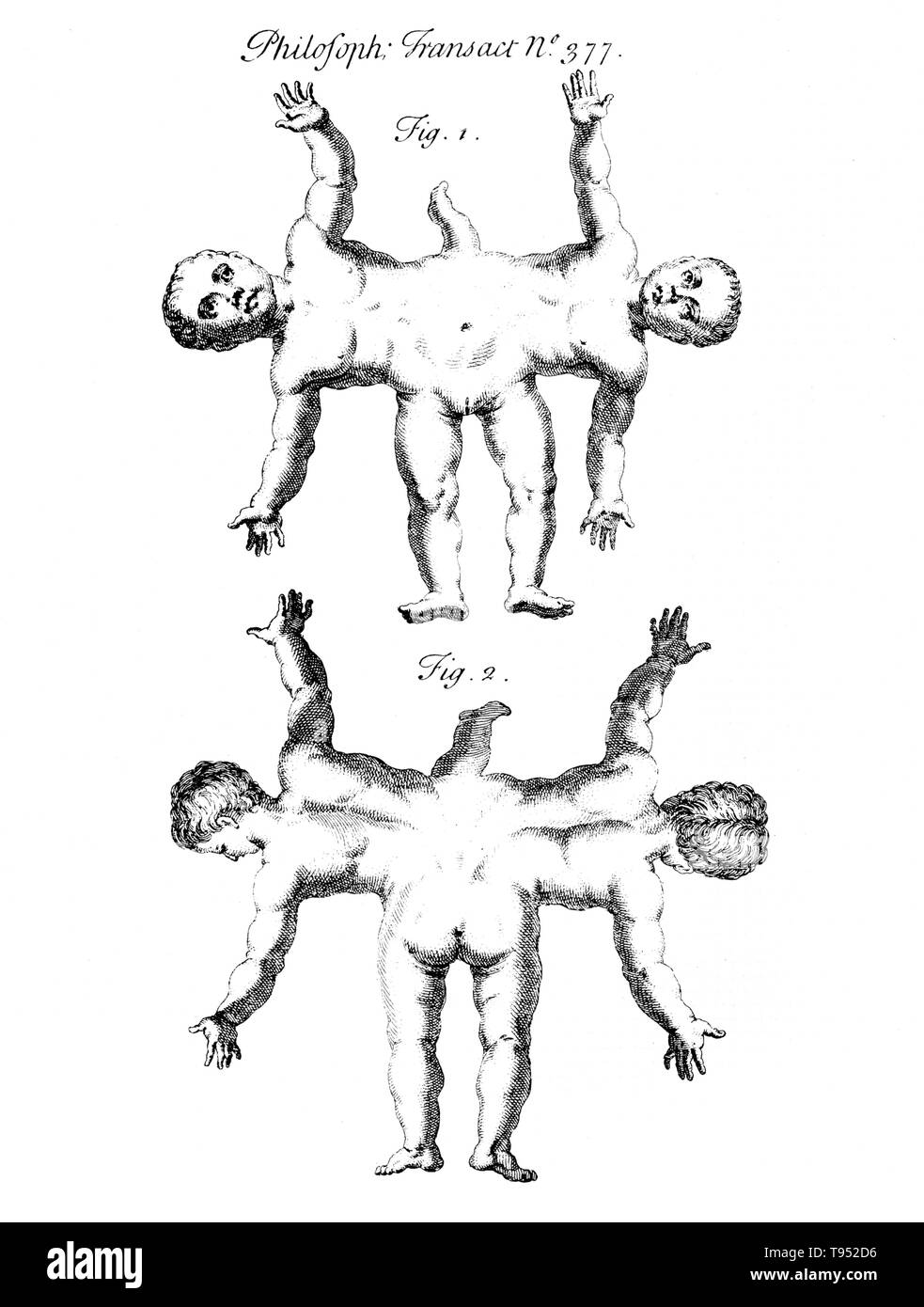 Conjoined twins are identical twins born with their bodies joined at some point and having varying degrees of residual duplication, a result of the incomplete division of the ovum from which the twins developed. Ischiopagus twins have fused lower half of the two bodies, with spines conjoined end-to-end at a 180 degree angle. These twins have four arms; two, three or four legs; and typically one external set of genitalia and anus. Image appeared in 'Philosophical transactions', Volume 31-32 Number 377, Firgure 1 & 2, published 1720-23. Stock Photo