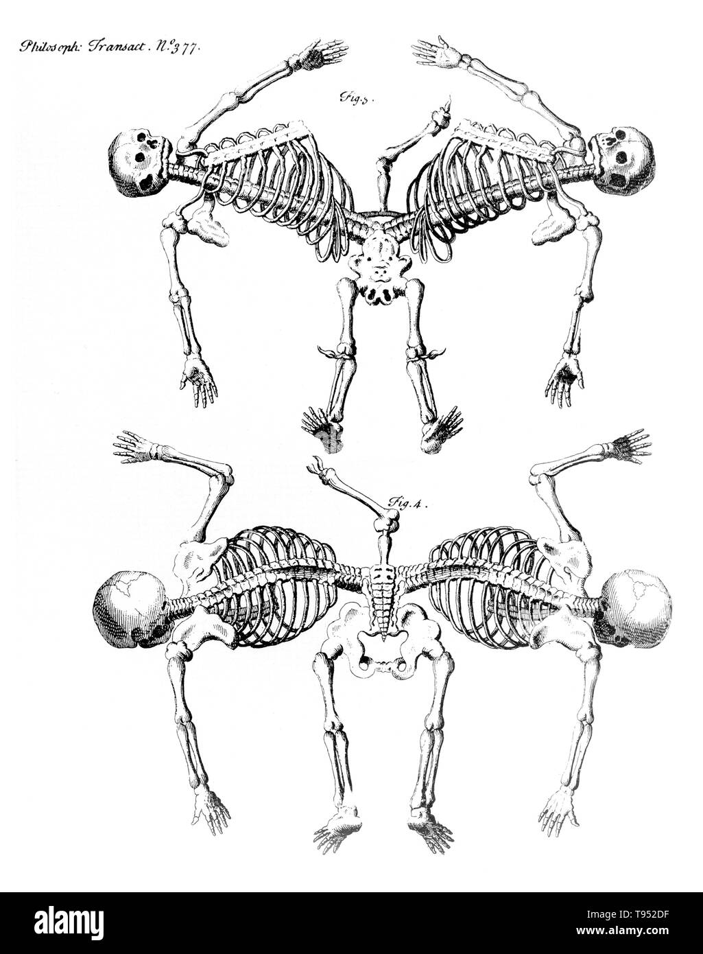Conjoined twins are identical twins born with their bodies joined at some point and having varying degrees of residual duplication, a result of the incomplete division of the ovum from which the twins developed. Ischiopagus twins have fused lower half of the two bodies, with spines conjoined end-to-end at a 180 degree angle. These twins have four arms; two, three or four legs; and typically one external set of genitalia and anus. Image appeared in 'Philosophical transactions', Volume 31-32 Number 377, Firgure 3 & 4, published 1720-23. Stock Photo