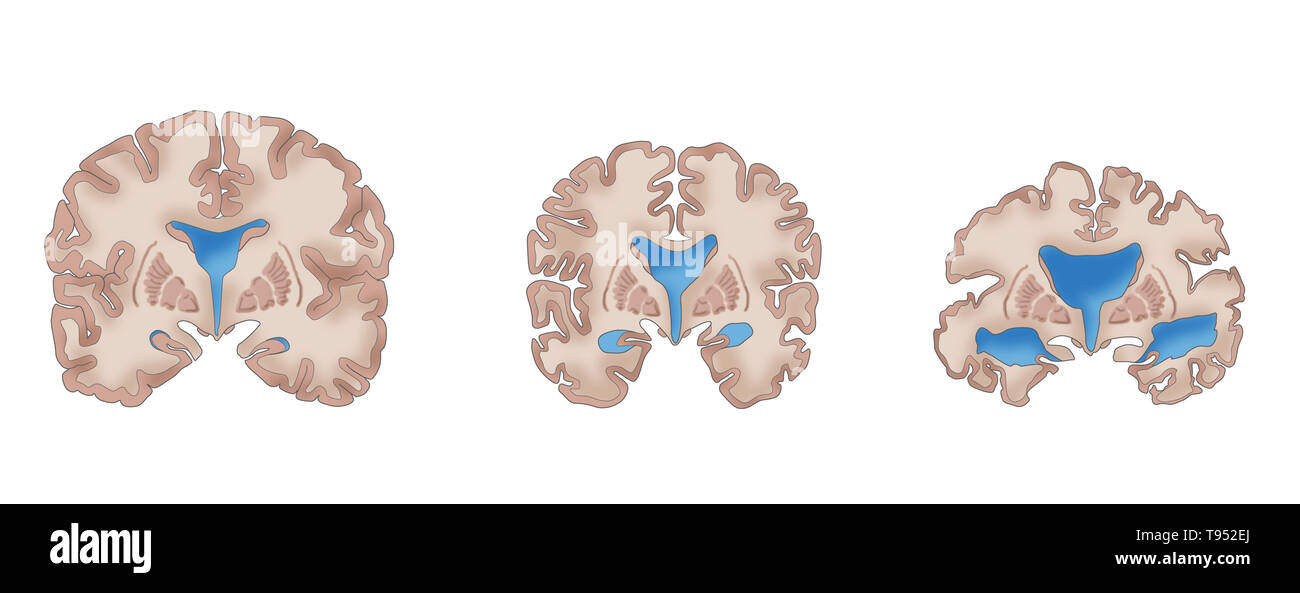 Illustration depicting the progression of Alzheimer's disease. On the left is a healthy brain. The middle brain displays cortical shrinkage, moderately enlarged ventricles, and a shrinking hippocampus, symptoms of mild Alzheimer's. The right brain shows severe cortical shrinkage, severely enlarged ventricles, and severe shrinkage of the hippocampus, indicative of severe Alzheimer's. Stock Photo