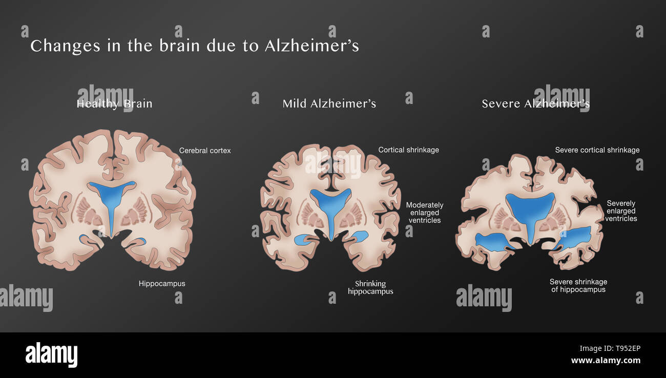 Illustration depicting the progression of Alzheimer's disease. On the left is a healthy brain. The middle brain displays cortical shrinkage, moderately enlarged ventricles, and a shrinking hippocampus, symptoms of mild Alzheimer's. The right brain shows severe cortical shrinkage, severely enlarged ventricles, and severe shrinkage of the hippocampus, indicative of severe Alzheimer's. Stock Photo