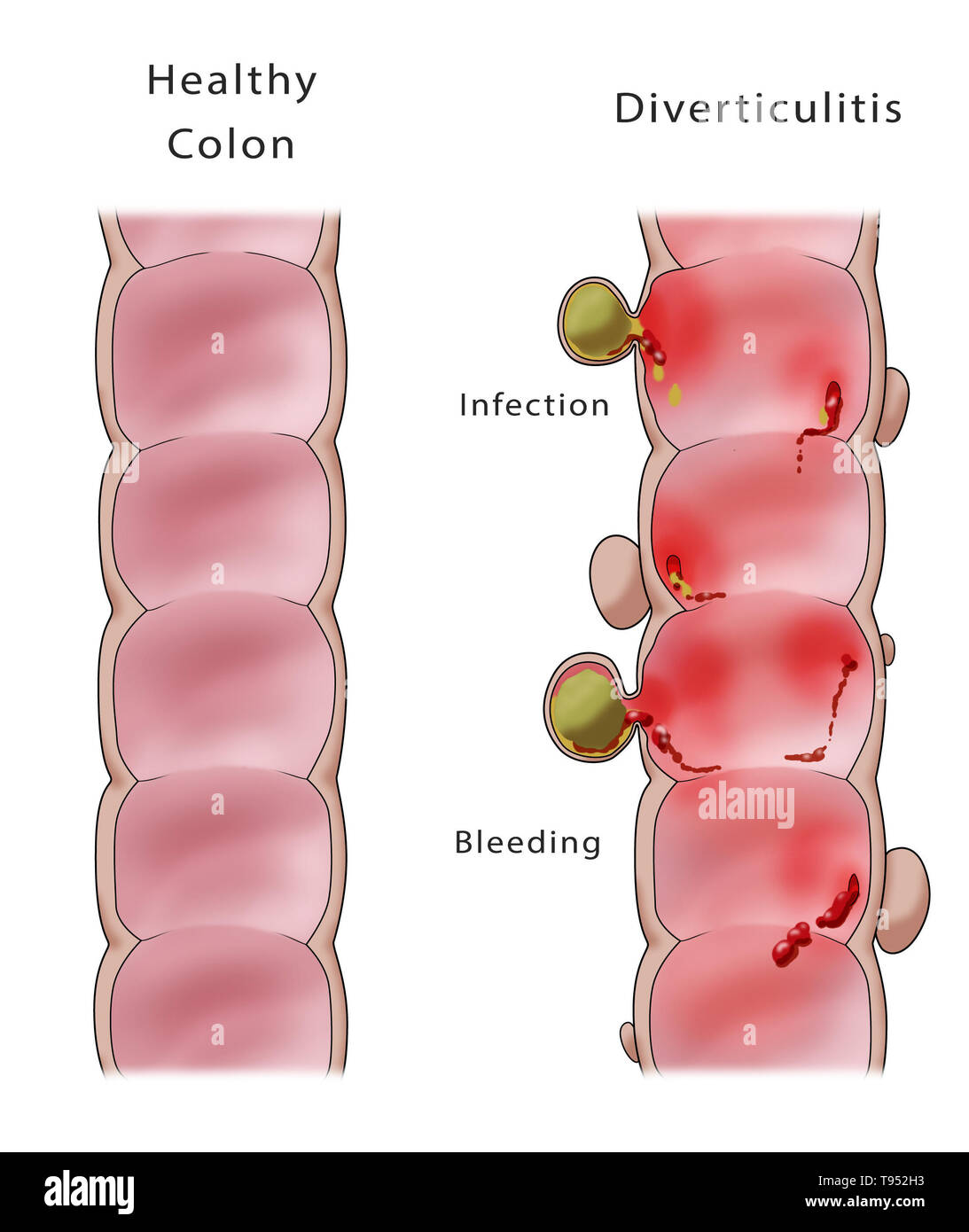 Illustration comparing a healthy colon (left) and a colon with diverticulitis (right). Stock Photo