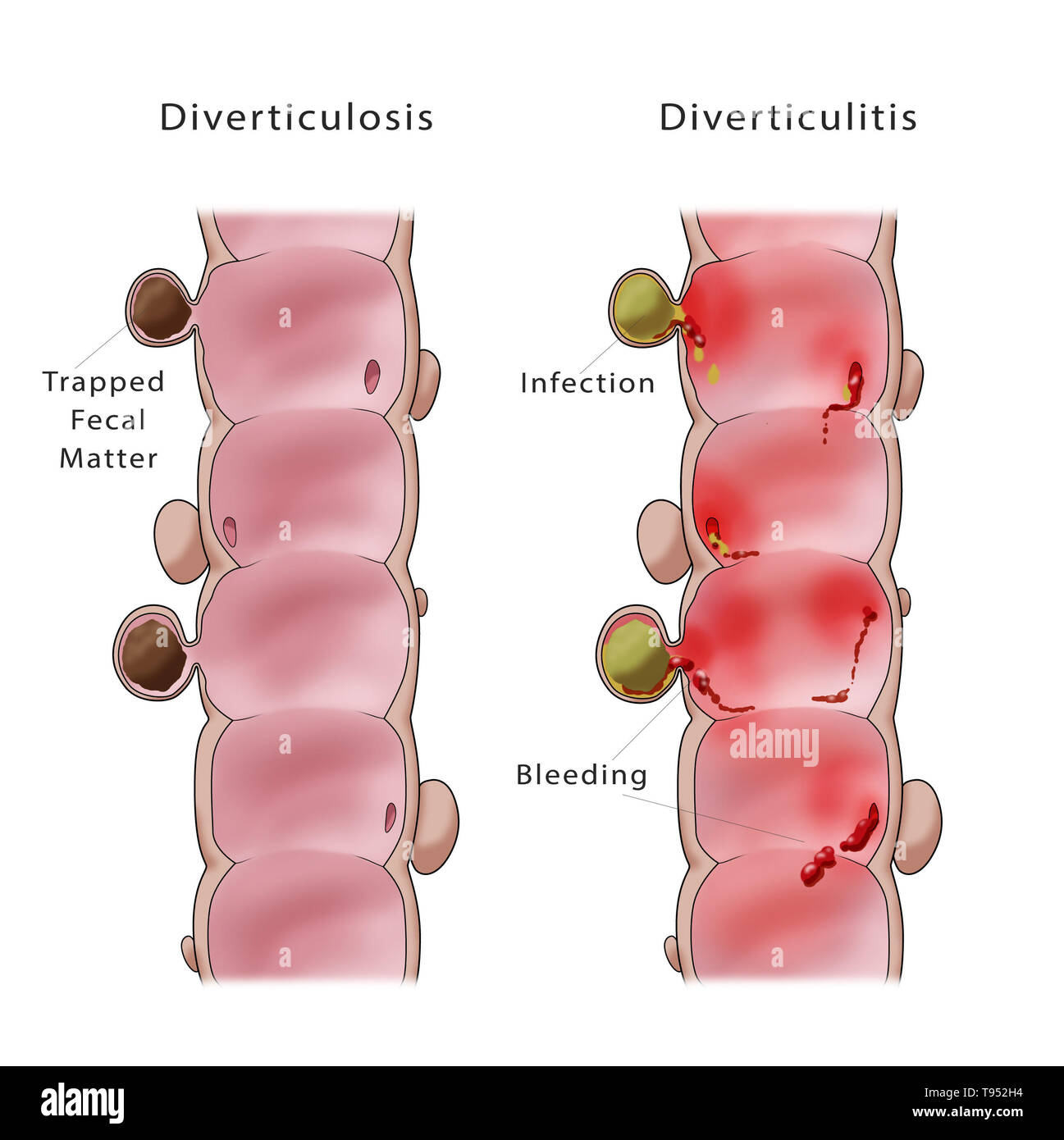 Illustration comparing a colon with diverticulosis (left) and diverticulitis (right). Stock Photo