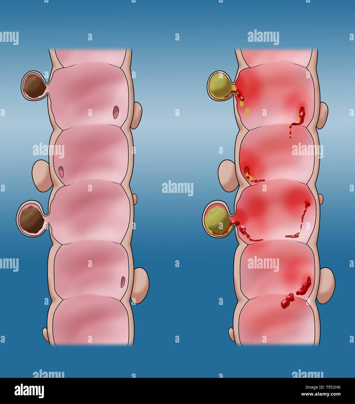 Illustration comparing a colon with diverticulosis (left) and diverticulitis (right). Stock Photo