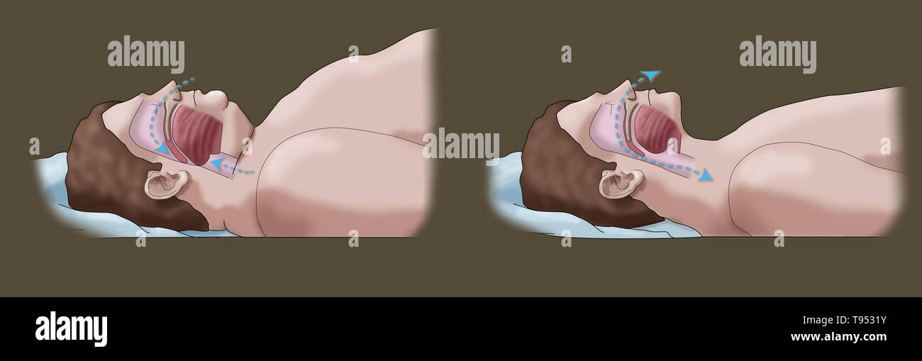 An illustration comparing an obese and normal sleeper. In adults, sleep apnea is commonly caused by excess weight and obesity. During sleep, when the throat and tongue muscles are more relaxed, soft tissue, excess fat deposits and the weight of abdominal fat pressing on the lungs can interfere with normal sleep. Stock Photo