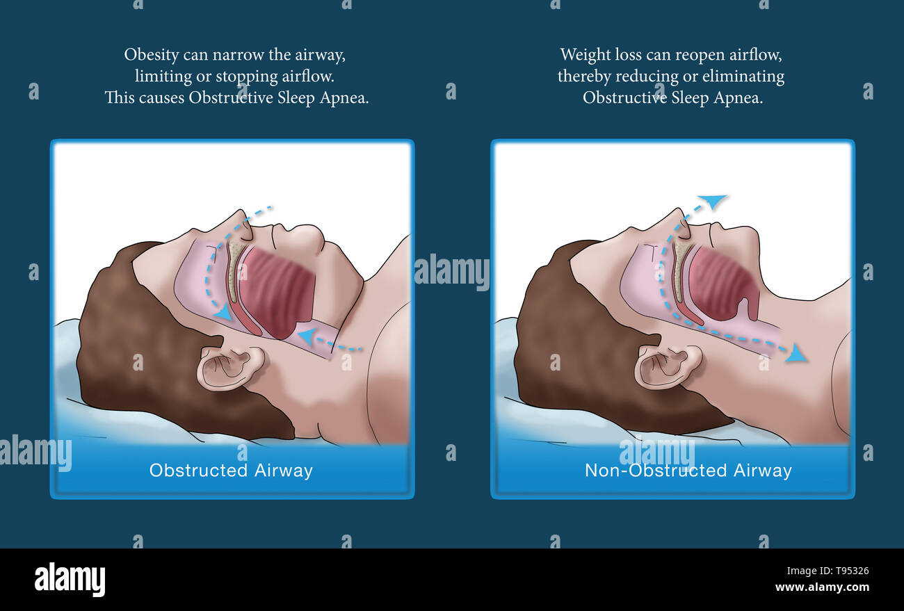 An illustration comparing an obese and normal sleeper. In adults, sleep apnea is commonly caused by excess weight and obesity. During sleep, when the throat and tongue muscles are more relaxed, soft tissue, excess fat deposits and the weight of abdominal fat pressing on the lungs can interfere with normal sleep. Stock Photo