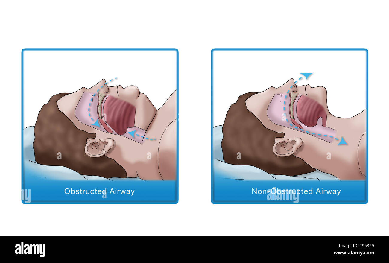 An illustration comparing an obese and normal sleeper. In adults, sleep apnea is commonly caused by excess weight and obesity. During sleep, when the throat and tongue muscles are more relaxed, soft tissue, excess fat deposits and the weight of abdominal fat pressing on the lungs can interfere with normal sleep. Stock Photo