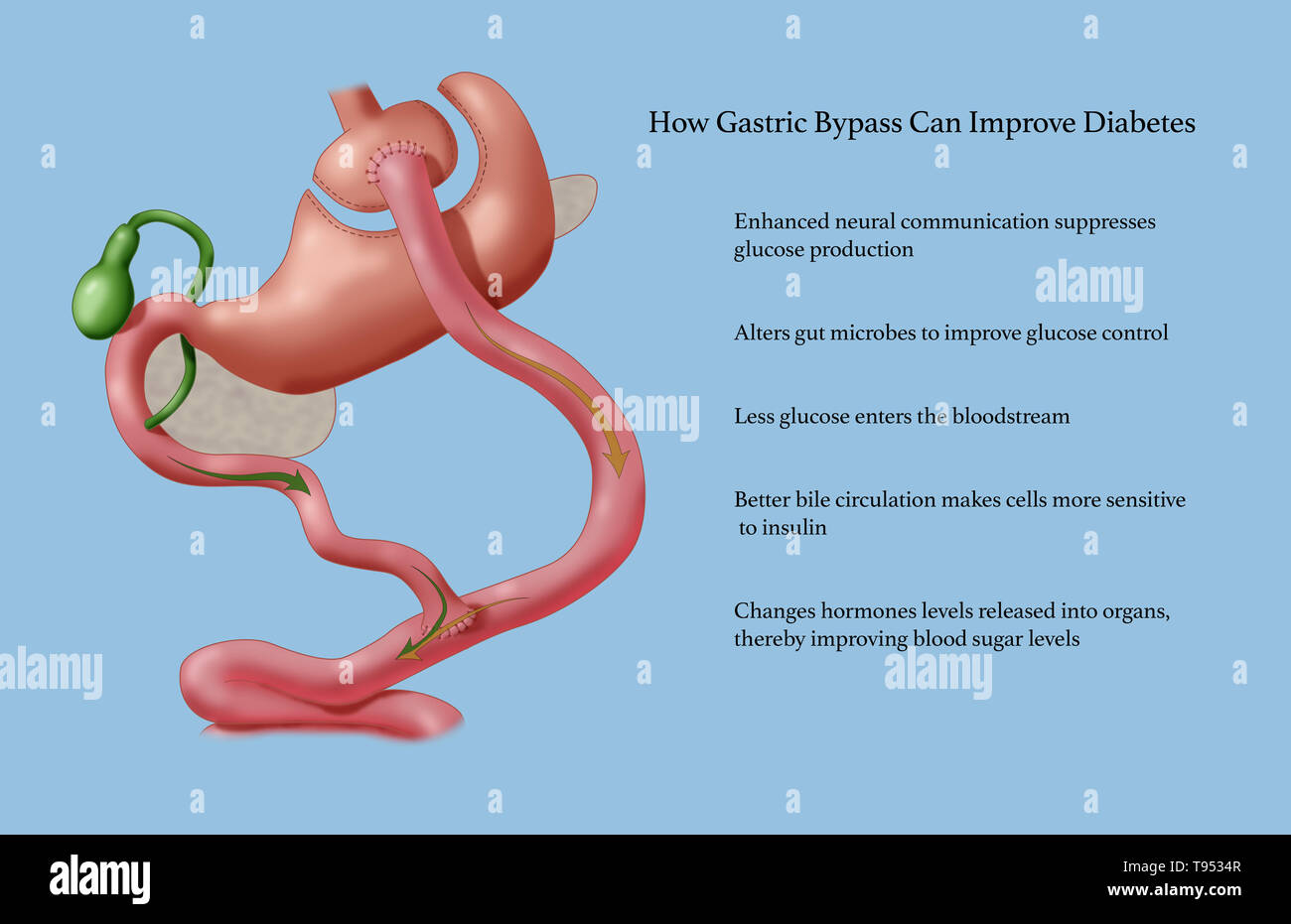 Roux-en-Y (RNY) gastric bypass is a weight loss surgery, or bariatric surgery, that is performed on patients who have tried and failed to lose weight losing using traditional methods. In Roux-en-Y gastric bypass, a small pouch at the top of the stomach is the only part of it that receives food, limiting intake. The small intestine is cut a short distance below the main stomach and connected to the new pouch. Food flows directly from the pouch into this part of the intestine. Stock Photo