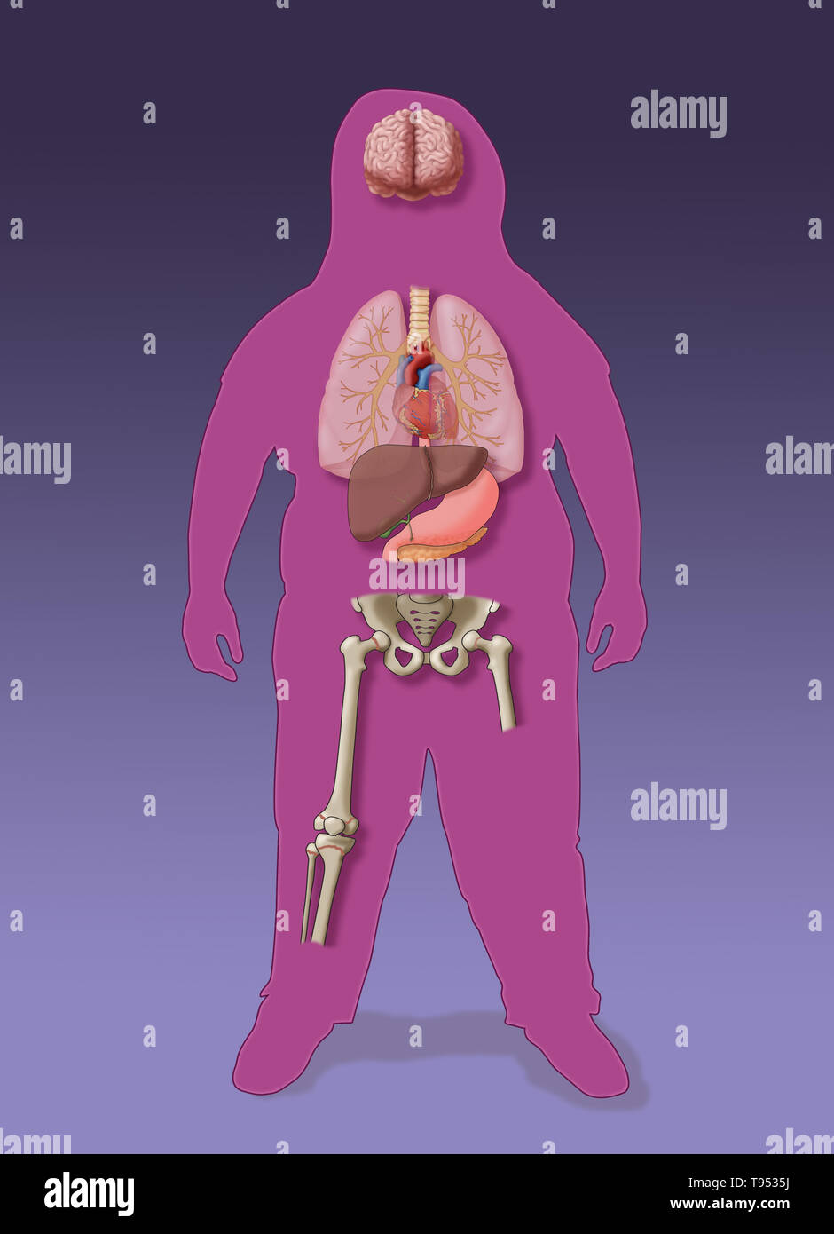 An illustration of the medical consequences of childhood obesity. Stock Photo