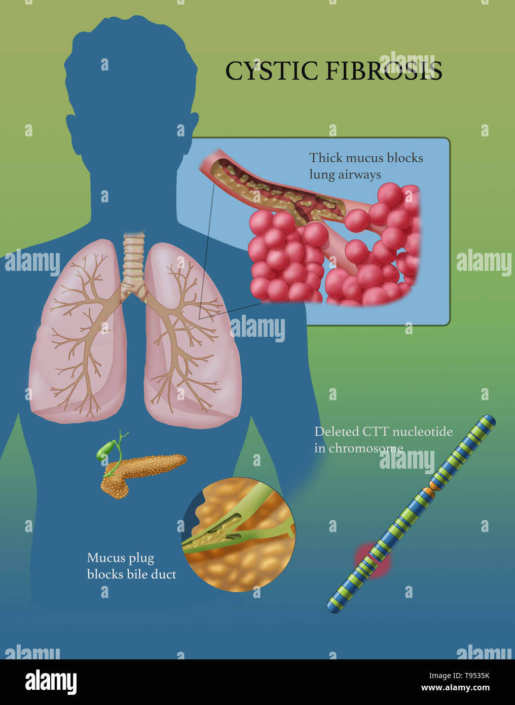 Cystic Fibrosis Cf Is A Genetic Disorder That Affects Mostly The Lungs But Also The Pancreas Liver Kidneys And Intestine Long Term Issues Include Difficulty Breathing And Coughing Up Mucus As A Result