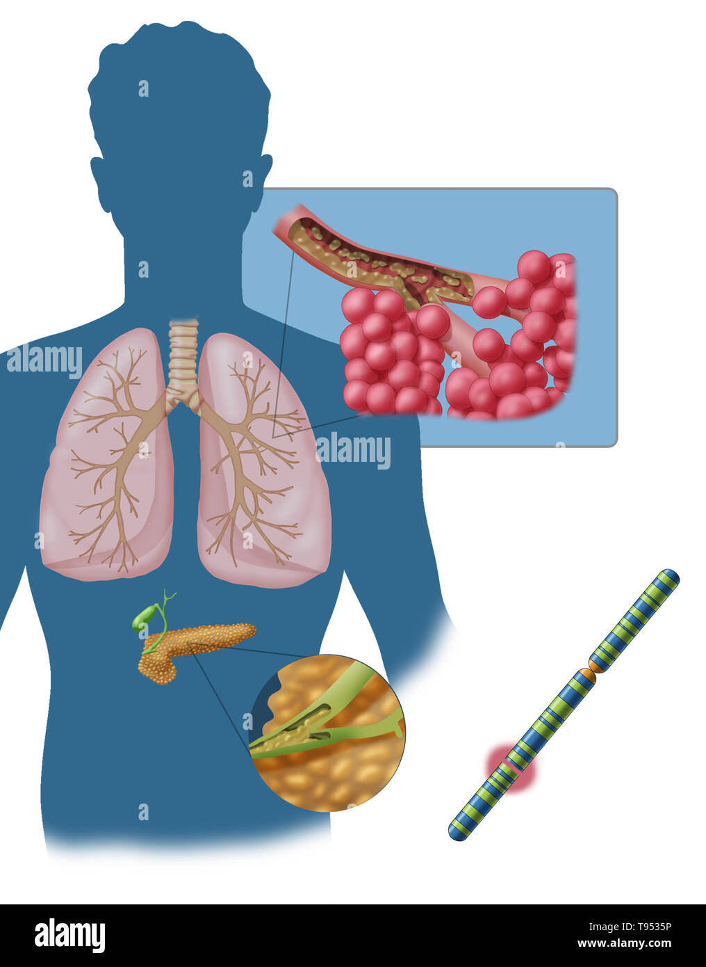 Cystic fibrosis (CF) is a genetic disorder that affects mostly the lungs, but also the pancreas, liver, kidneys, and intestine. Long-term issues include difficulty breathing and coughing up mucus as a result of frequent lung infections. Other signs and symptoms may include sinus infections, poor growth, fatty stool, clubbing of the fingers and toes, and infertility in some males. Different people may have different degrees of symptoms. Stock Photo