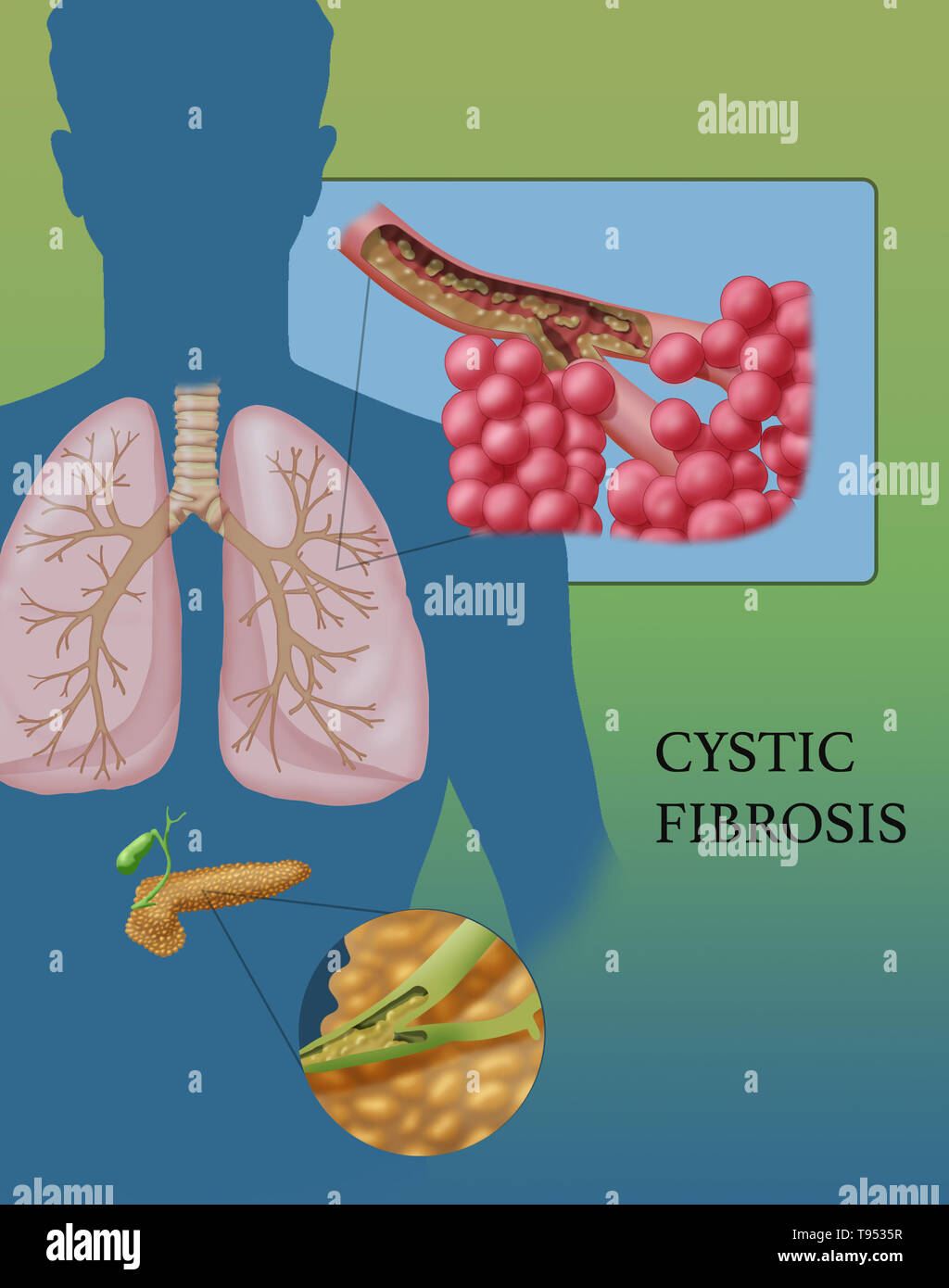 Cystic fibrosis (CF) is a genetic disorder that affects mostly the lungs, but also the pancreas, liver, kidneys, and intestine. Long-term issues include difficulty breathing and coughing up mucus as a result of frequent lung infections. Other signs and symptoms may include sinus infections, poor growth, fatty stool, clubbing of the fingers and toes, and infertility in some males. Different people may have different degrees of symptoms. Stock Photo