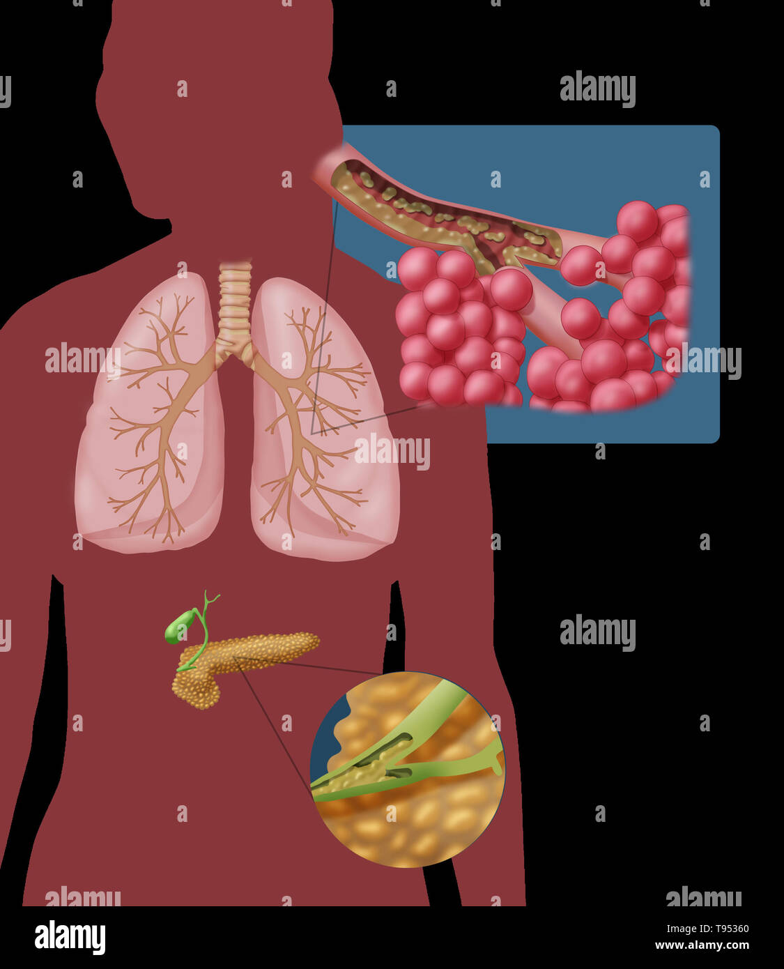 Cystic fibrosis (CF) is a genetic disorder that affects mostly the lungs, but also the pancreas, liver, kidneys, and intestine. Long-term issues include difficulty breathing and coughing up mucus as a result of frequent lung infections. Other signs and symptoms may include sinus infections, poor growth, fatty stool, clubbing of the fingers and toes, and infertility in some males. Different people may have different degrees of symptoms. Stock Photo