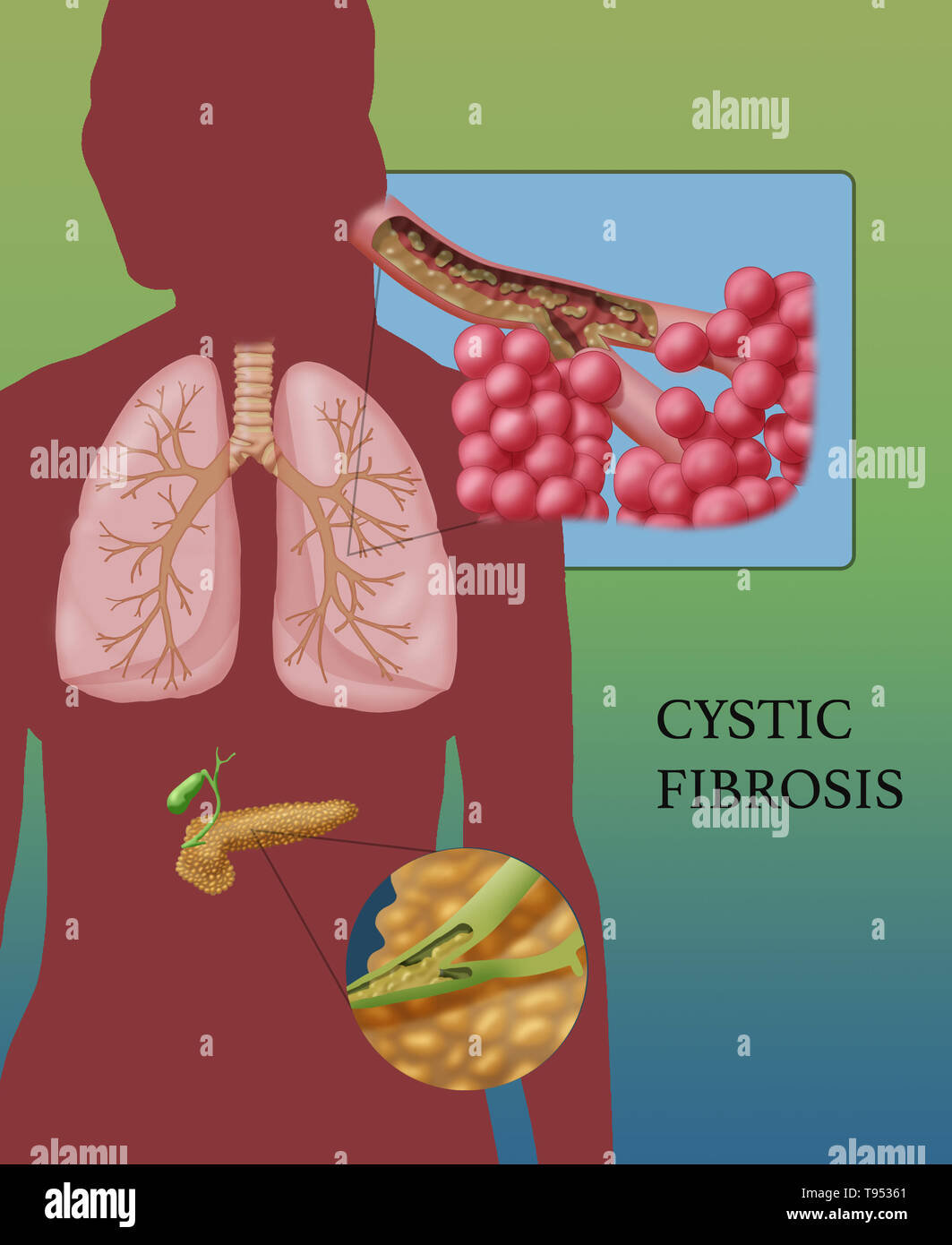 Cystic fibrosis (CF) is a genetic disorder that affects mostly the lungs, but also the pancreas, liver, kidneys, and intestine. Long-term issues include difficulty breathing and coughing up mucus as a result of frequent lung infections. Other signs and symptoms may include sinus infections, poor growth, fatty stool, clubbing of the fingers and toes, and infertility in some males. Different people may have different degrees of symptoms. Stock Photo