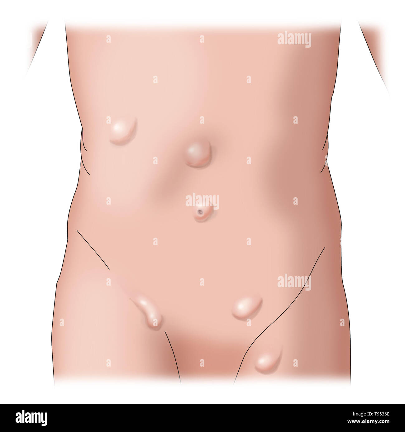 An illustration showing the various types of hernias. Stock Photo
