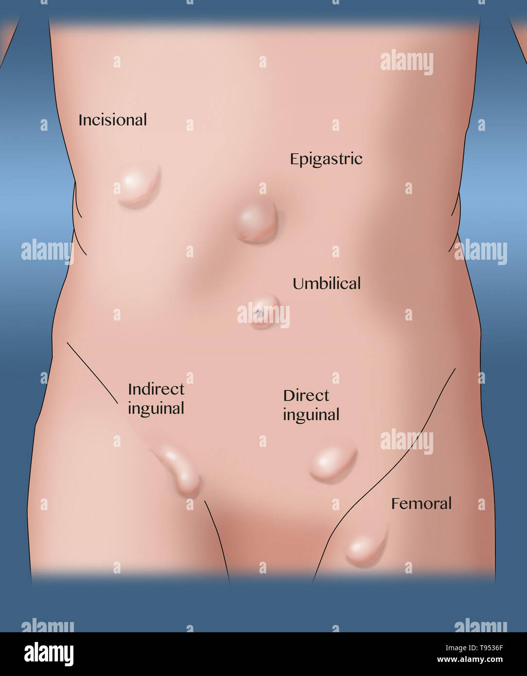 An Illustration Showing The Various Types Of Hernias Stock Photo Alamy
