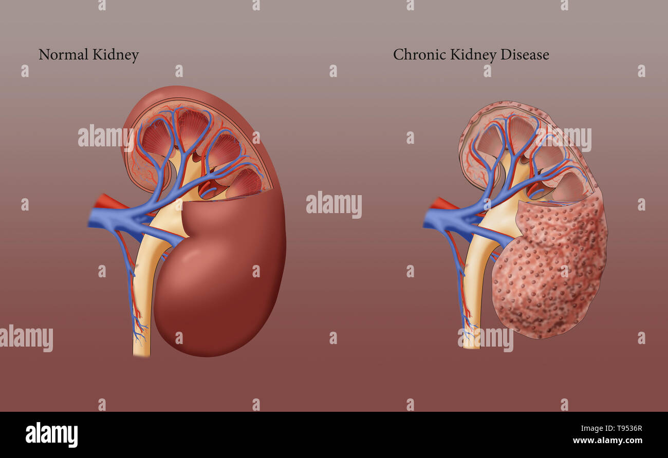 An illustration of a kidney with chronic kidney disease (right), next to a healthy kidney (left). Stock Photo