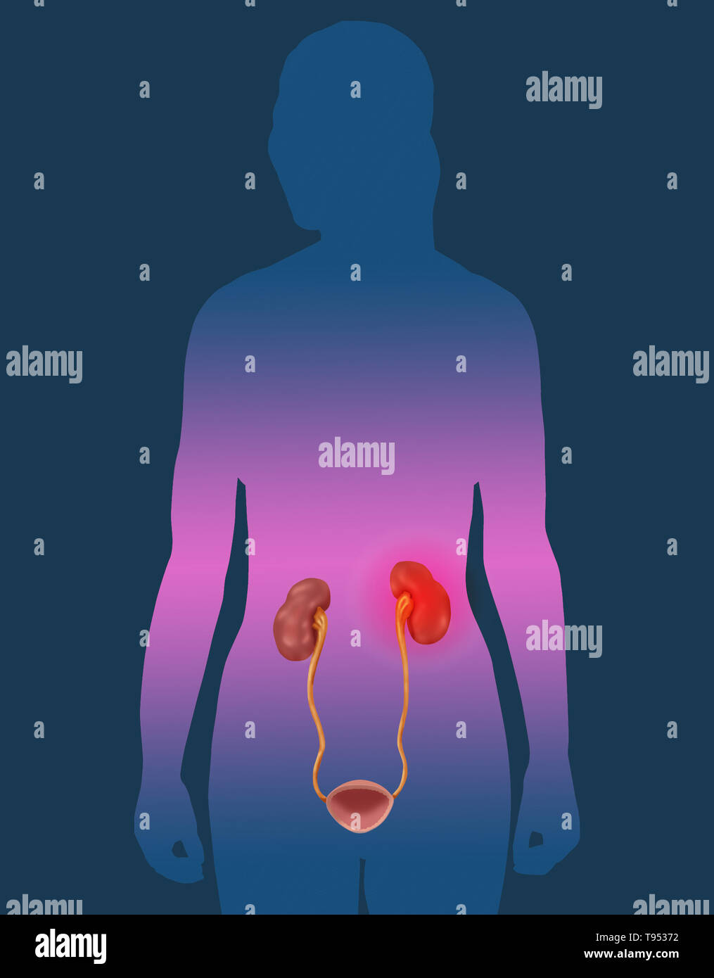 Kidney disease illustration hires stock photography and images Alamy