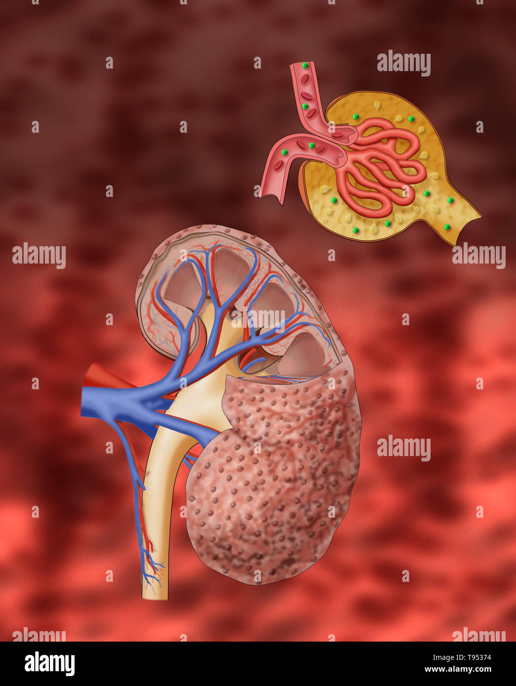 In chronic kidney disease (CKD) damaged capillaries in the glomerulus ...