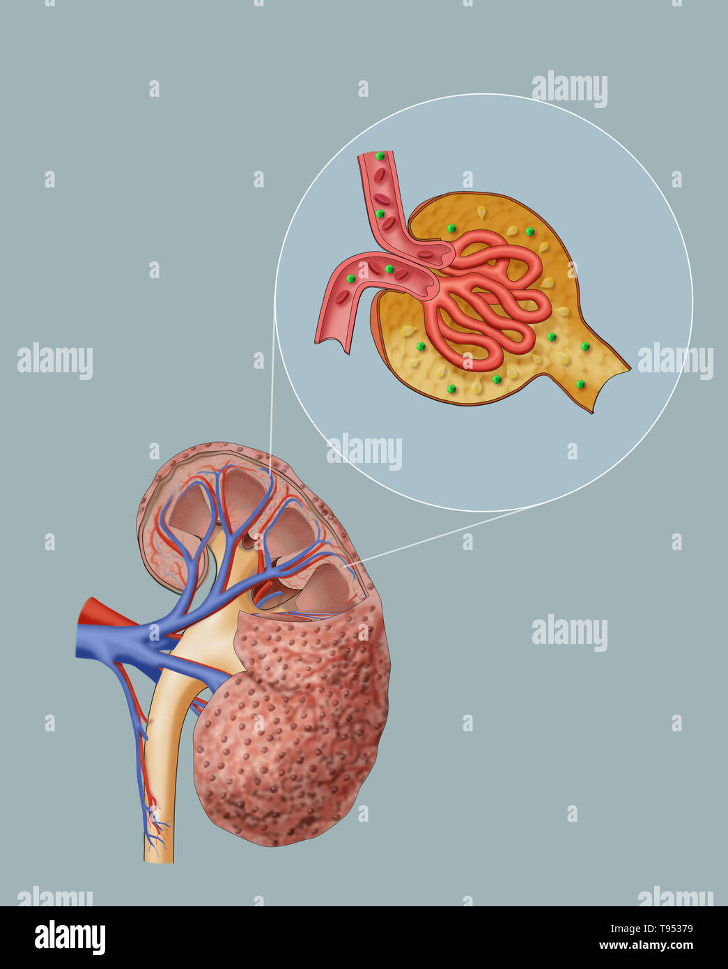 In chronic kidney disease (CKD) damaged capillaries in the glomerulus ...